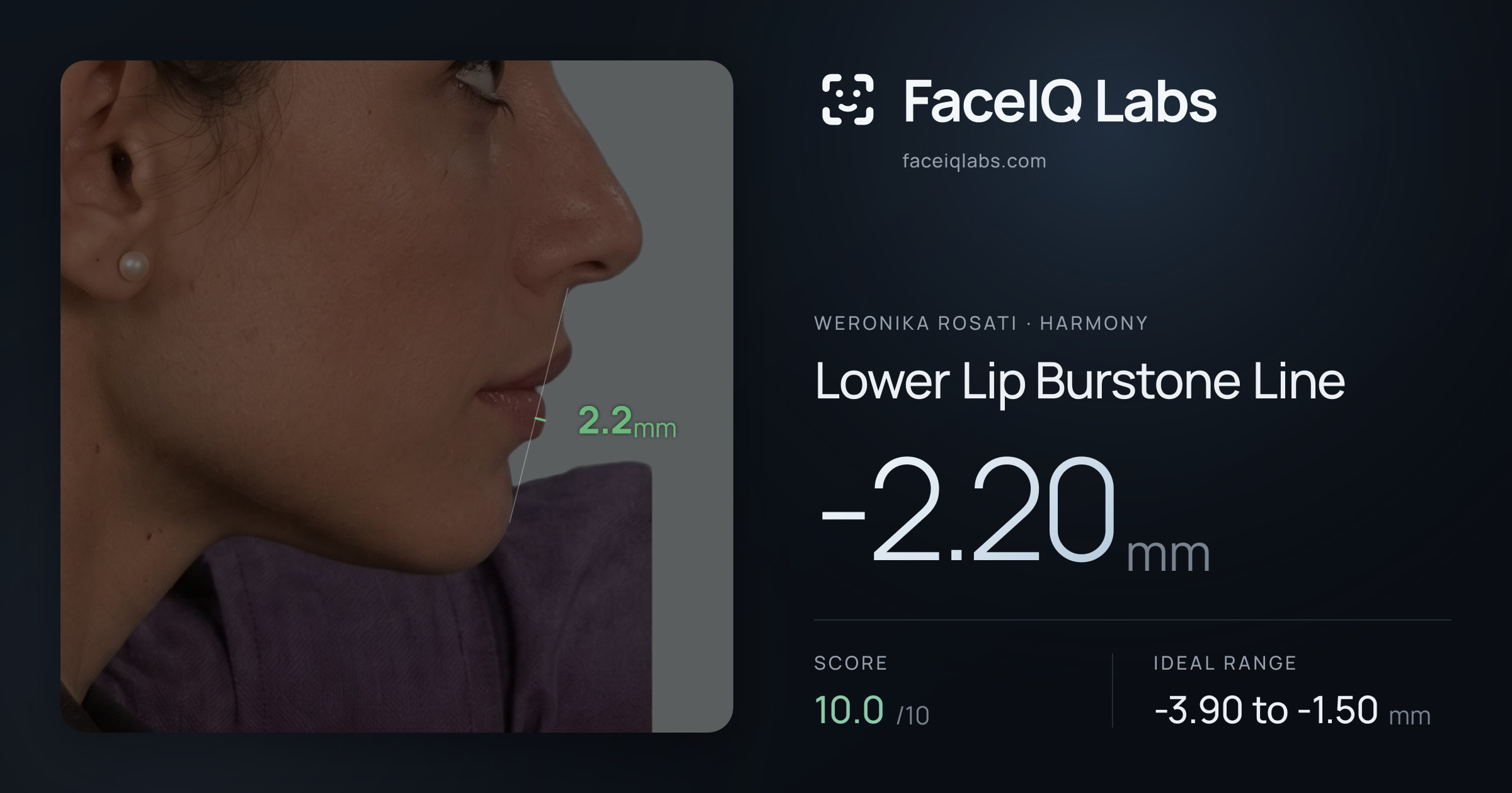 Weronika Rosati Lower Lip Burstone Line: -2.20mm, drawn on the photo