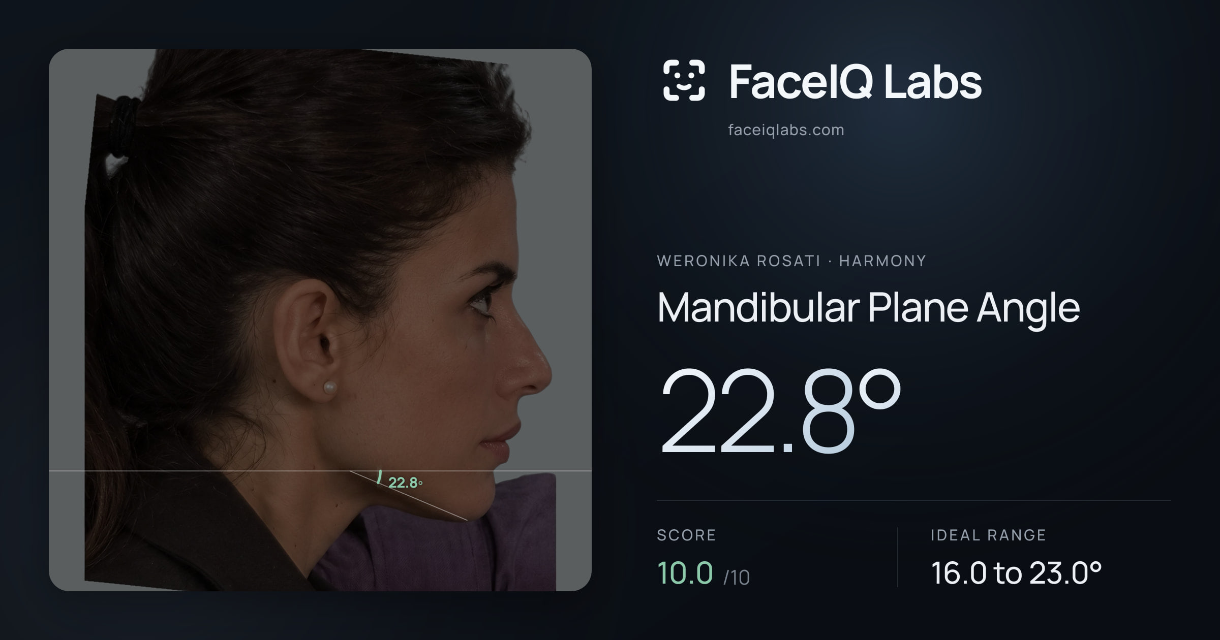 Weronika Rosati Mandibular Plane Angle: 22.8°, drawn on the photo