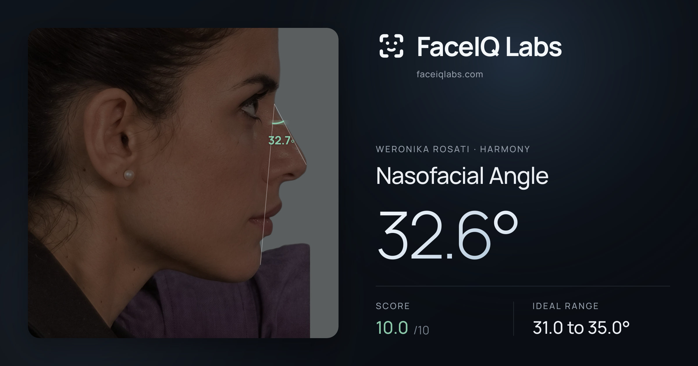 Weronika Rosati Nasofacial Angle: 32.6°, drawn on the photo