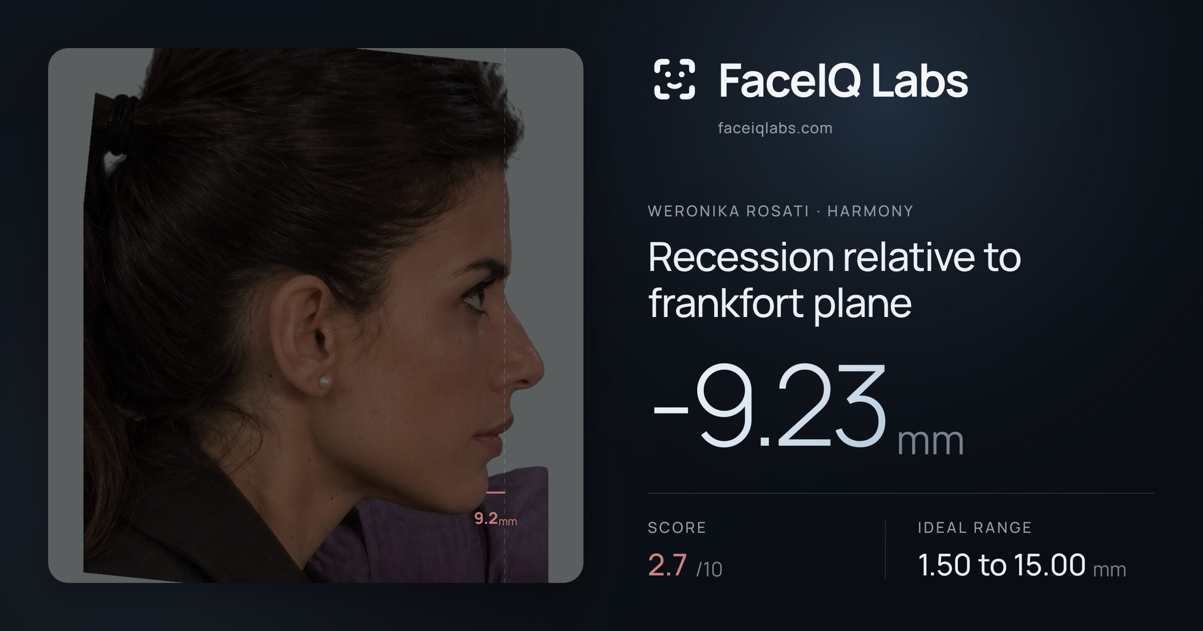 Weronika Rosati Recession relative to frankfort plane: -9.23mm, drawn on the photo