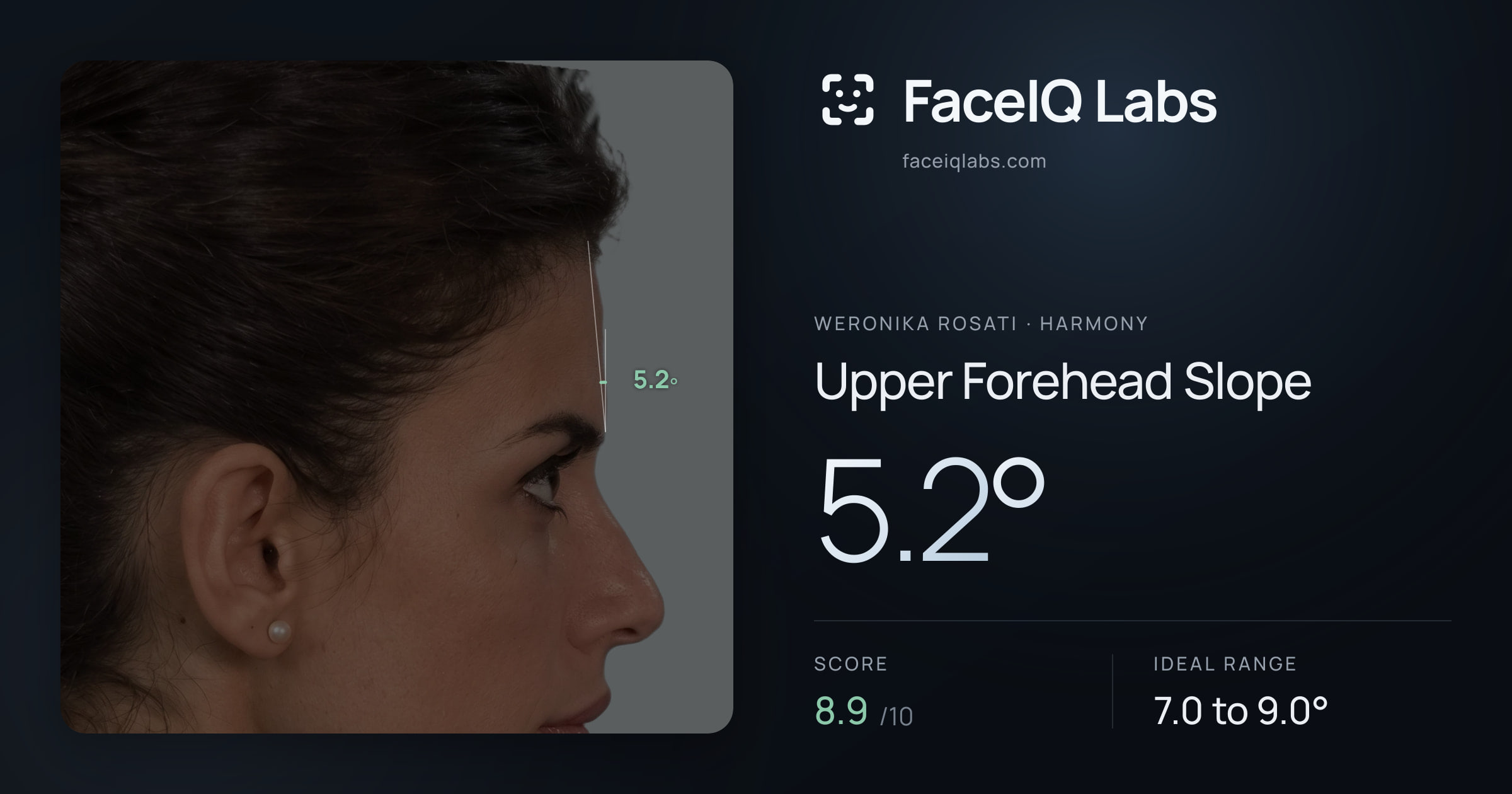 Weronika Rosati Upper Forehead Slope: 5.2°, drawn on the photo