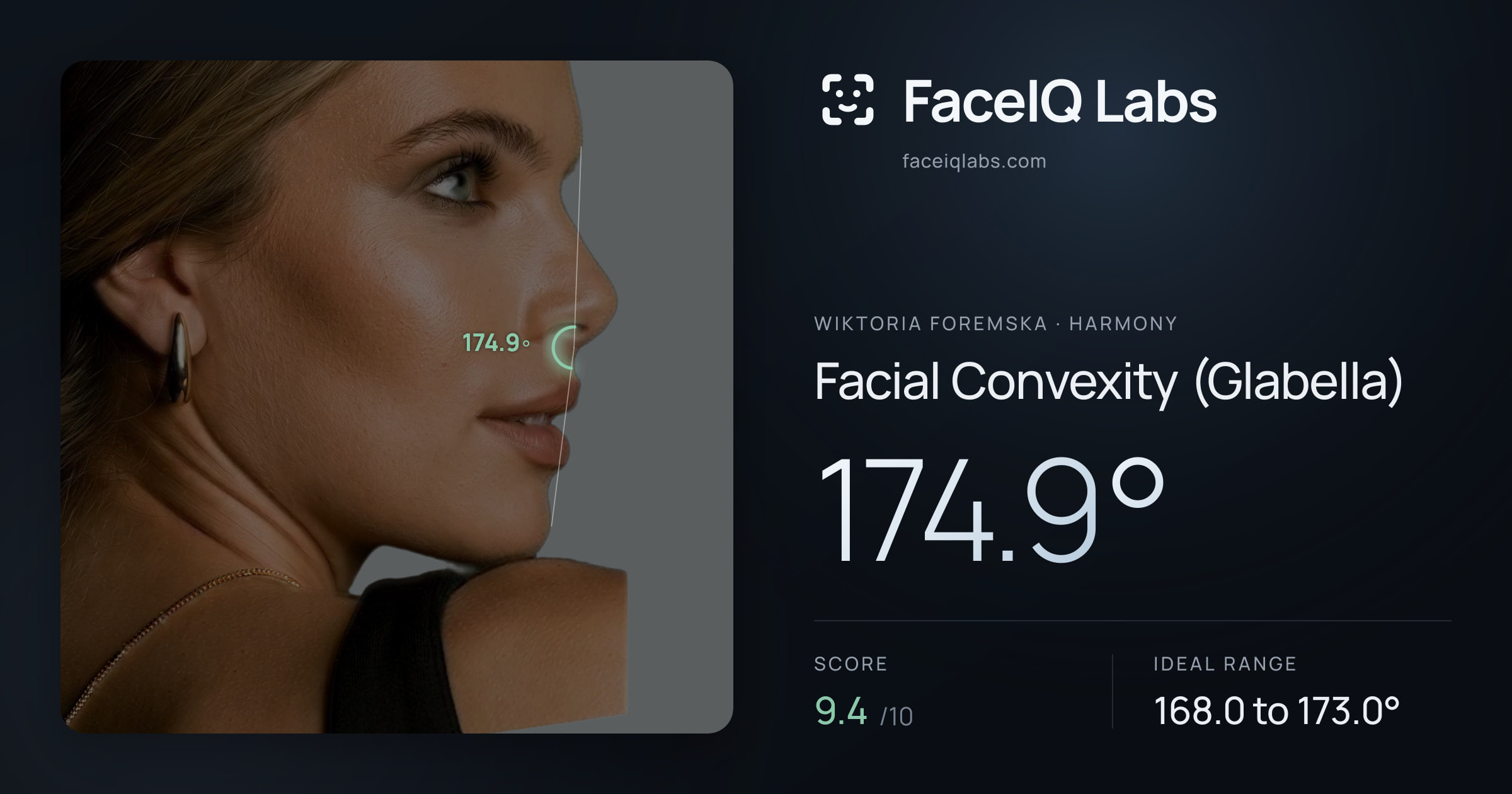 Wiktoria Foremska Facial Convexity (Glabella): 174.9°, drawn on the photo