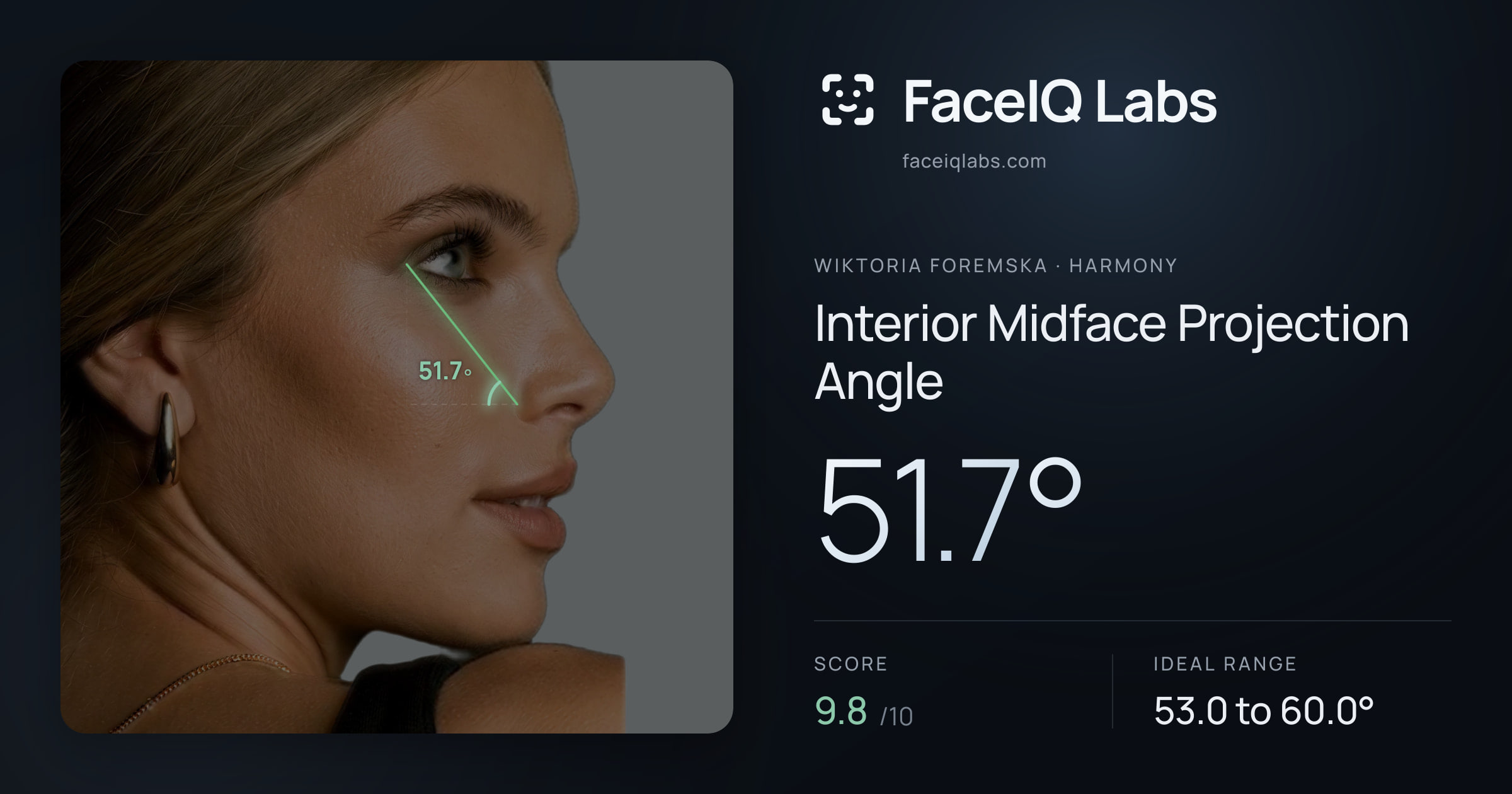 Wiktoria Foremska Interior Midface Projection Angle: 51.7°, drawn on the photo