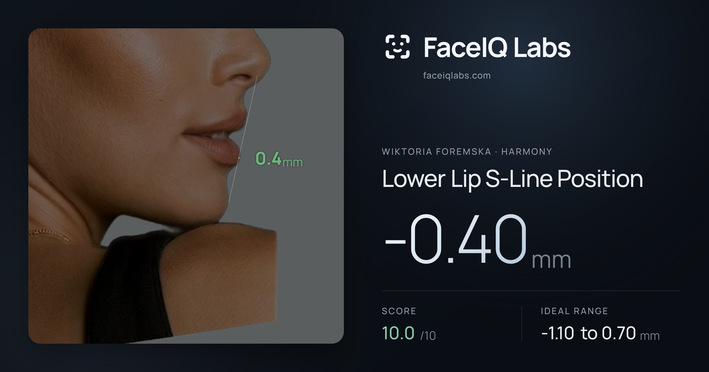 Wiktoria Foremska Lower Lip S-Line Position: -0.40mm, drawn on the photo