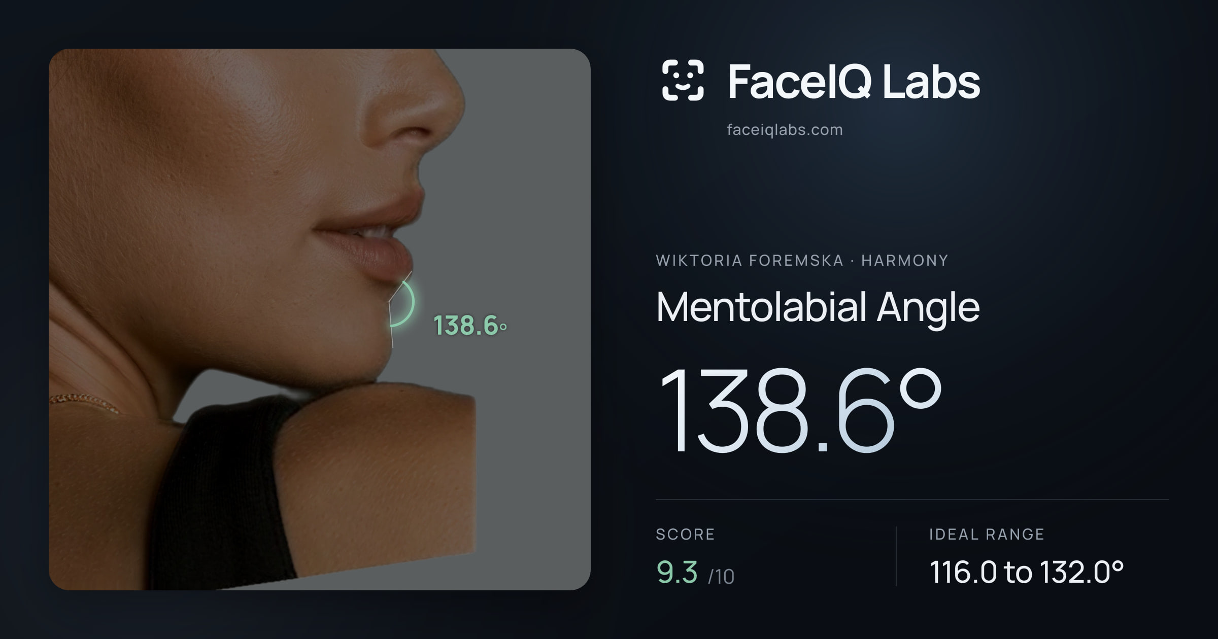 Wiktoria Foremska Mentolabial Angle: 138.6°, drawn on the photo