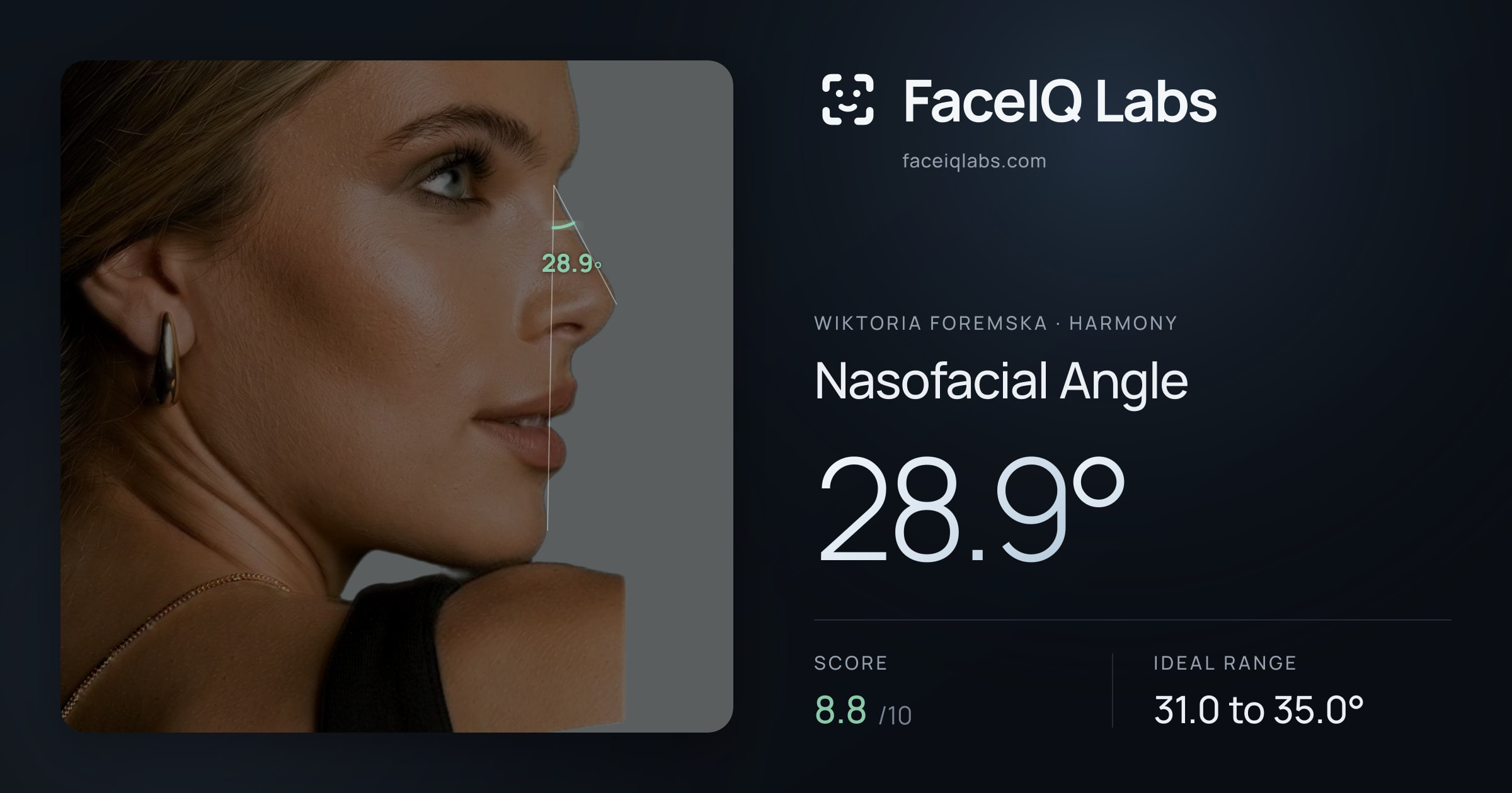 Wiktoria Foremska Nasofacial Angle: 28.9°, drawn on the photo