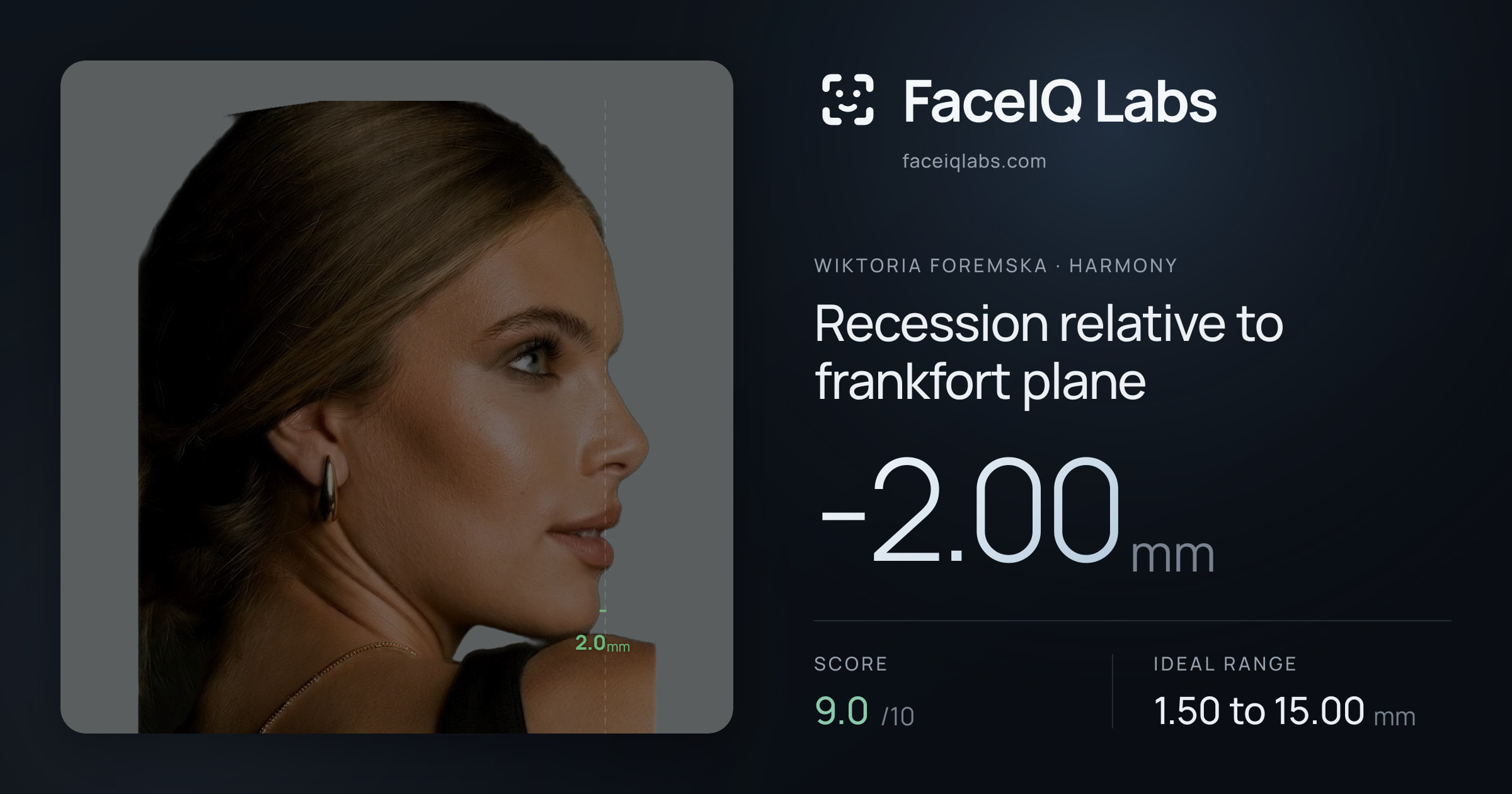 Wiktoria Foremska Recession relative to frankfort plane: -2.00mm, drawn on the photo