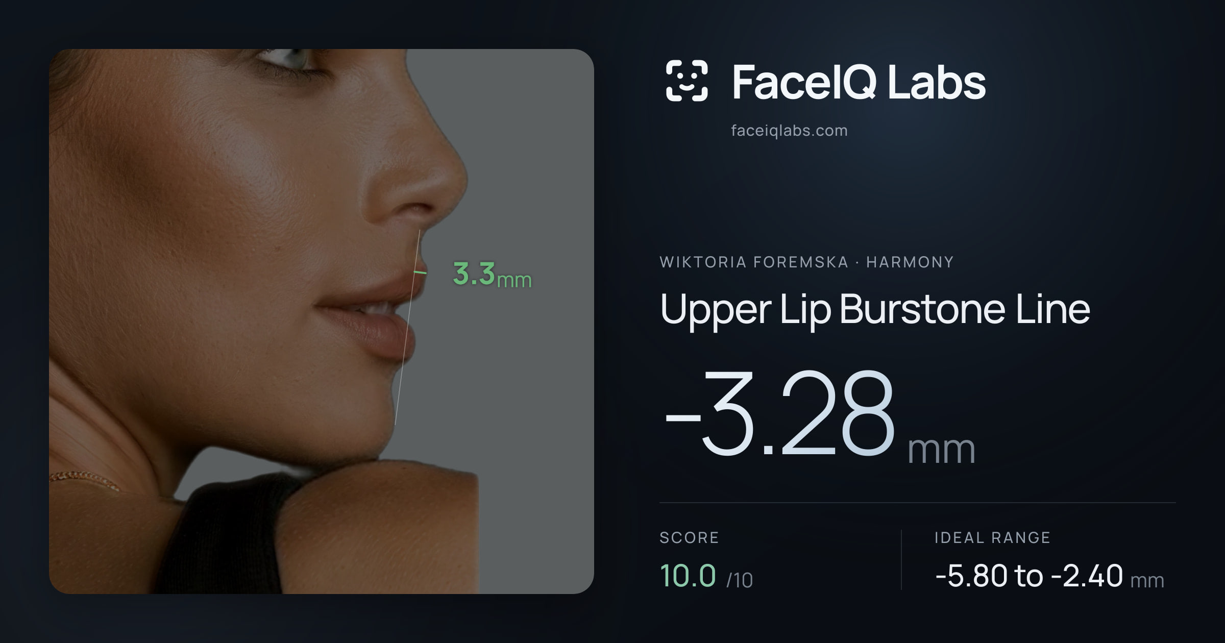 Wiktoria Foremska Upper Lip Burstone Line: -3.28mm, drawn on the photo