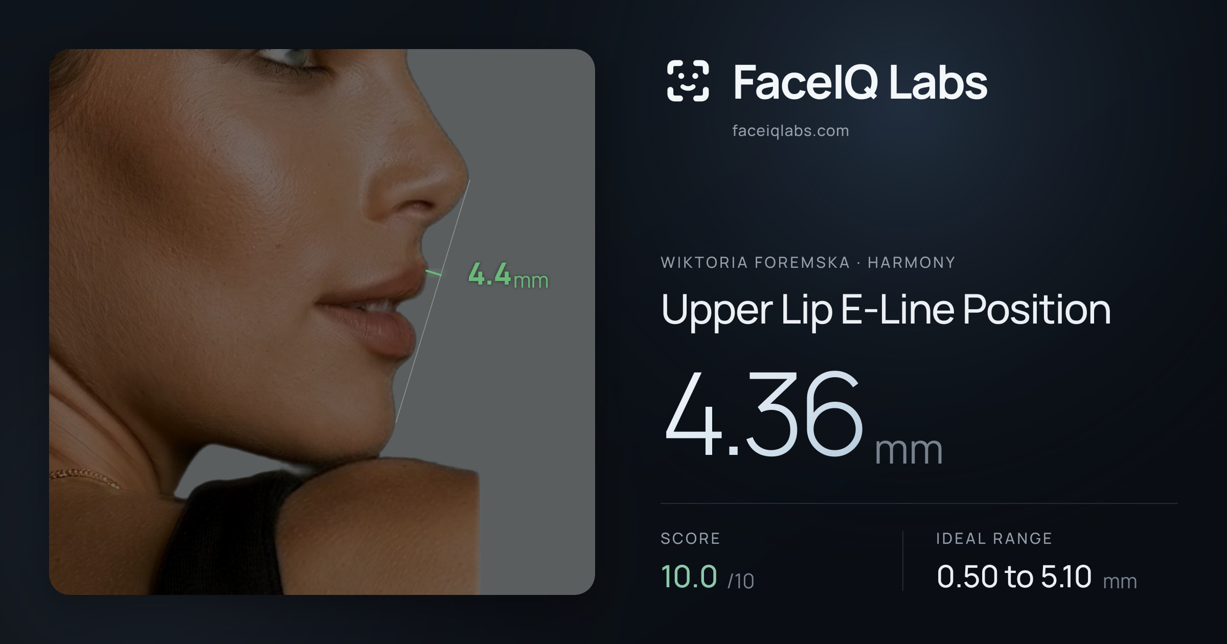 Wiktoria Foremska Upper Lip E-Line Position: 4.36mm, drawn on the photo