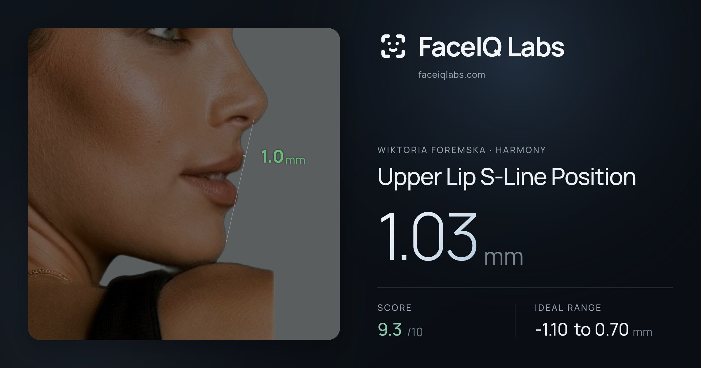 Wiktoria Foremska Upper Lip S-Line Position: 1.03mm, drawn on the photo