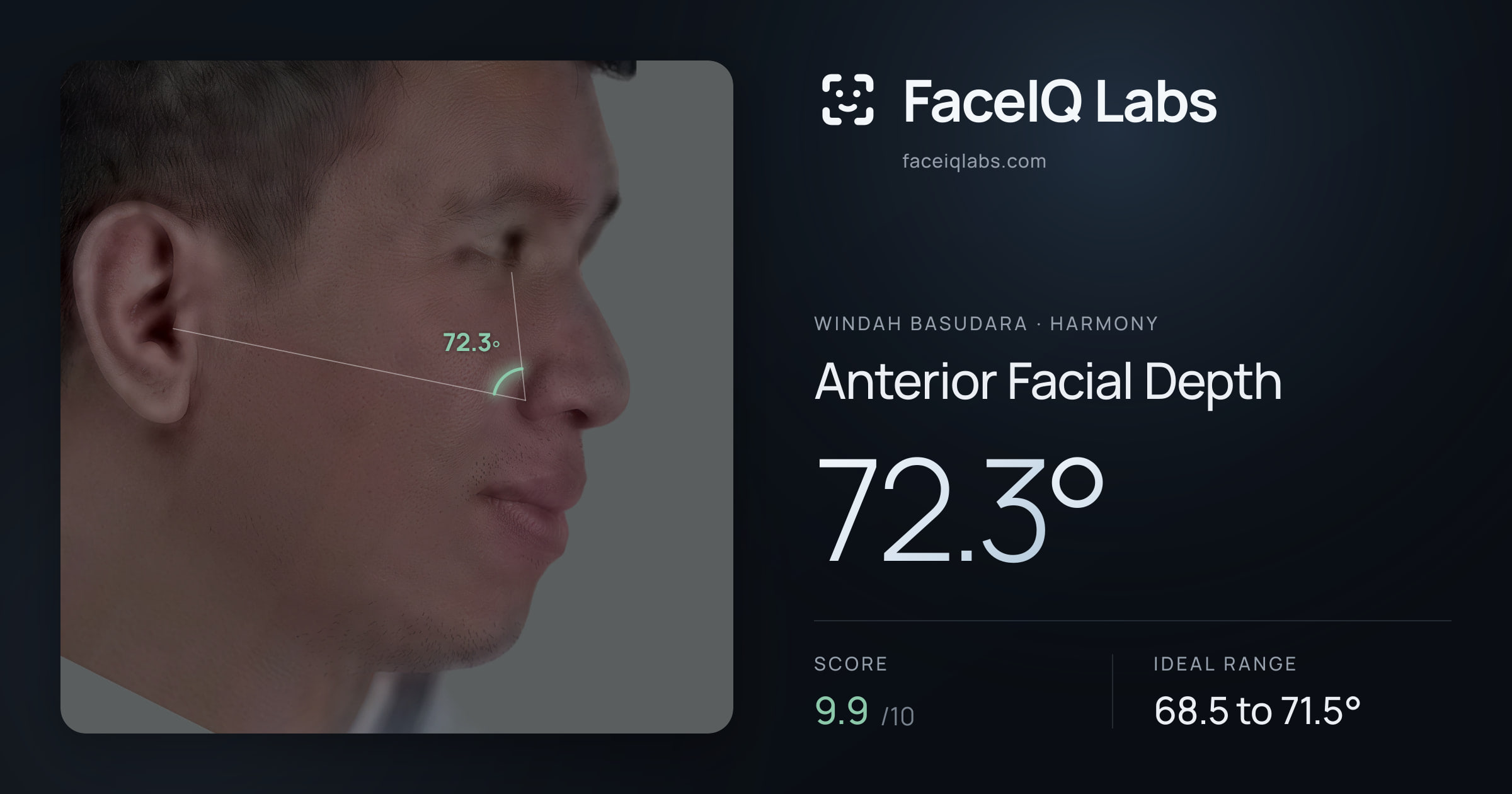 Windah Basudara Anterior Facial Depth: 72.3°, drawn on the photo
