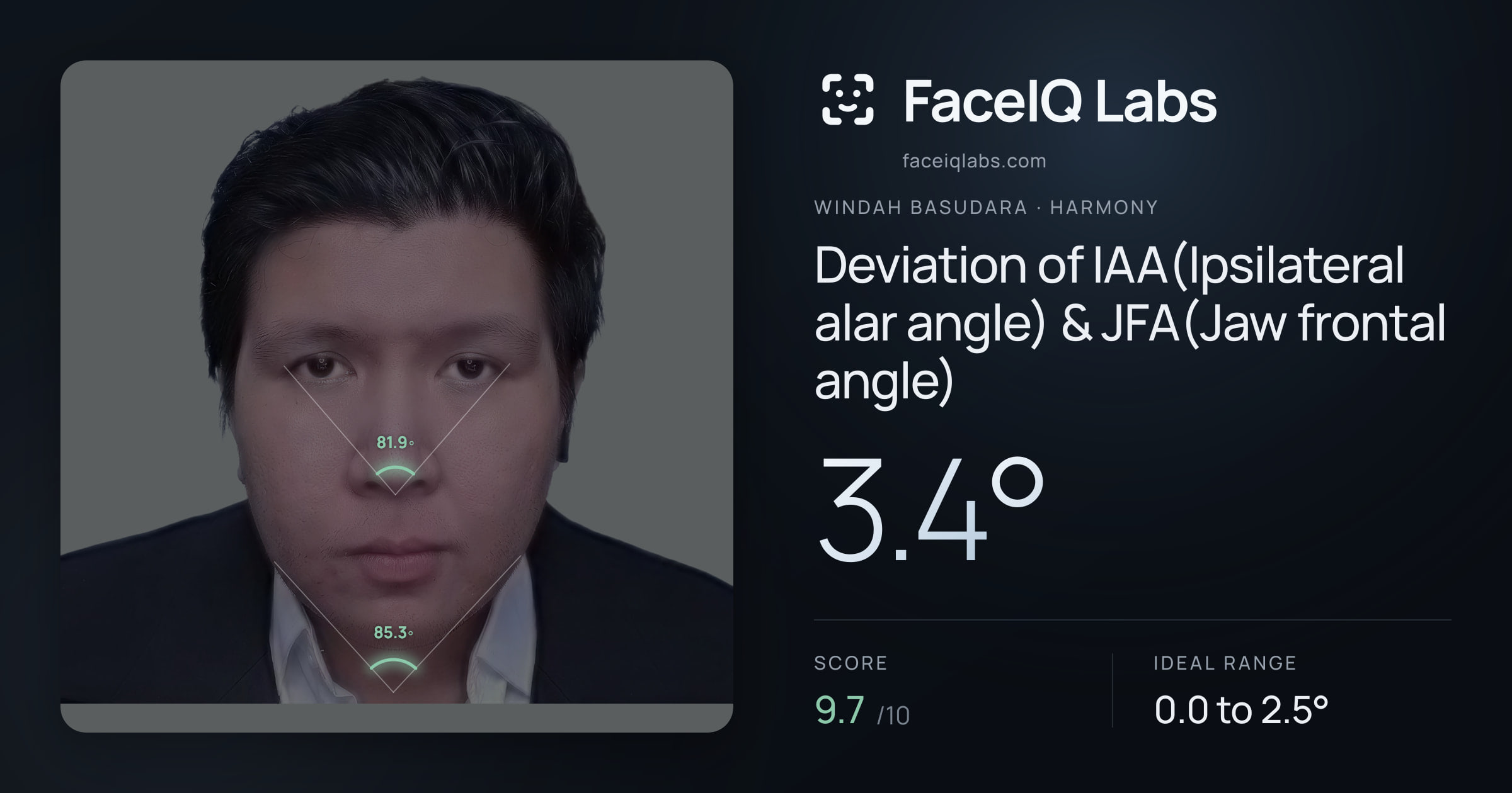 Windah Basudara Deviation of IAA(Ipsilateral alar angle) & JFA(Jaw frontal angle): 3.4°, drawn on the photo