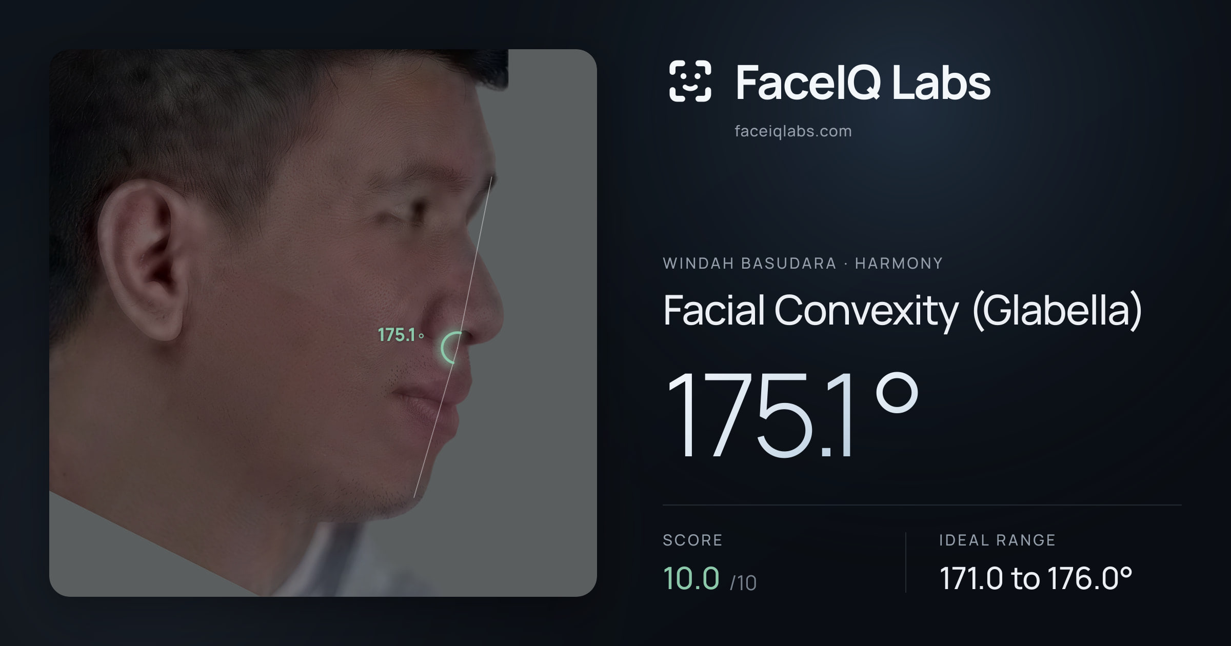 Windah Basudara Facial Convexity (Glabella): 175.1°, drawn on the photo