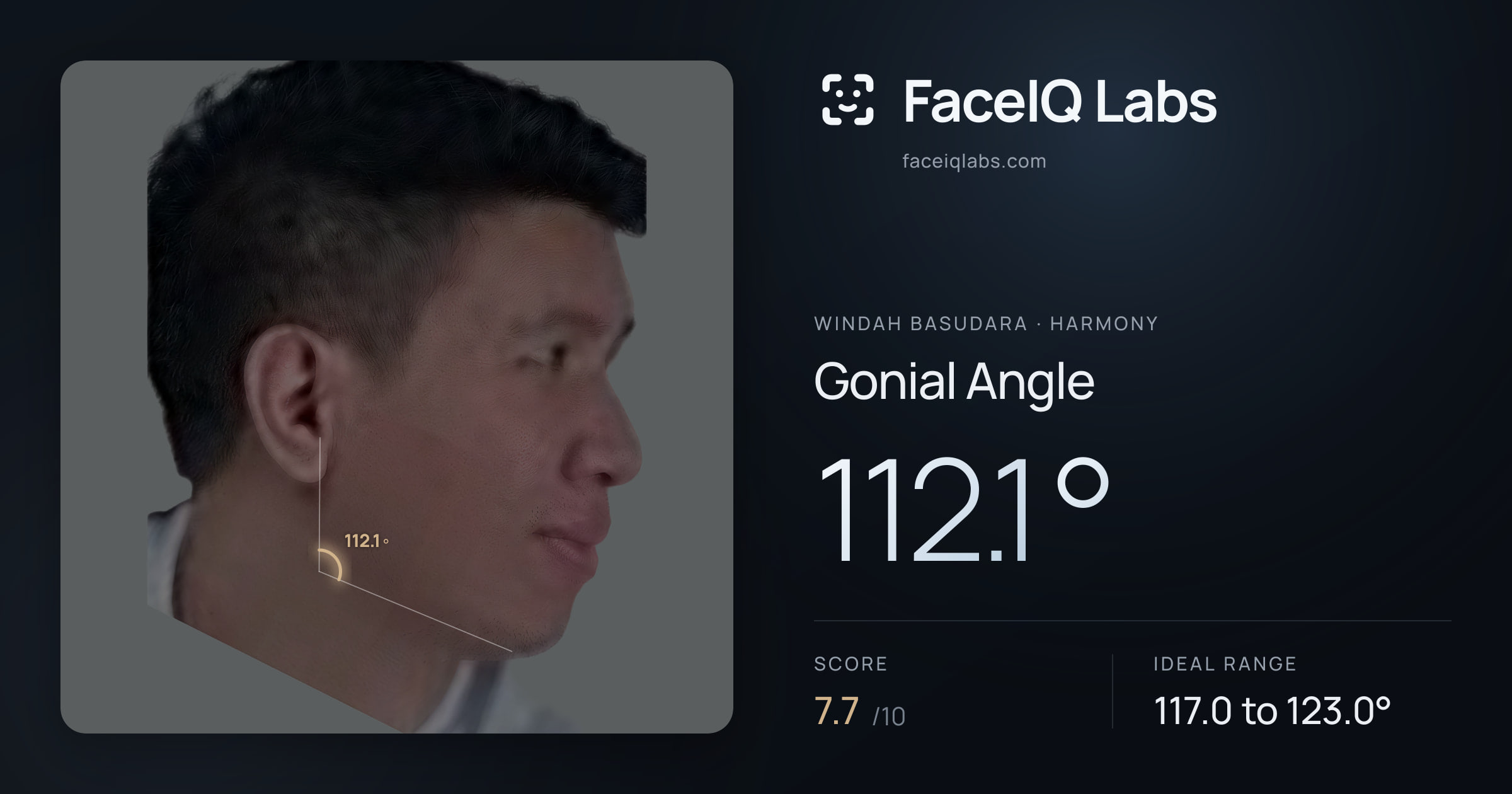 Windah Basudara Gonial Angle: 112.1°, drawn on the photo