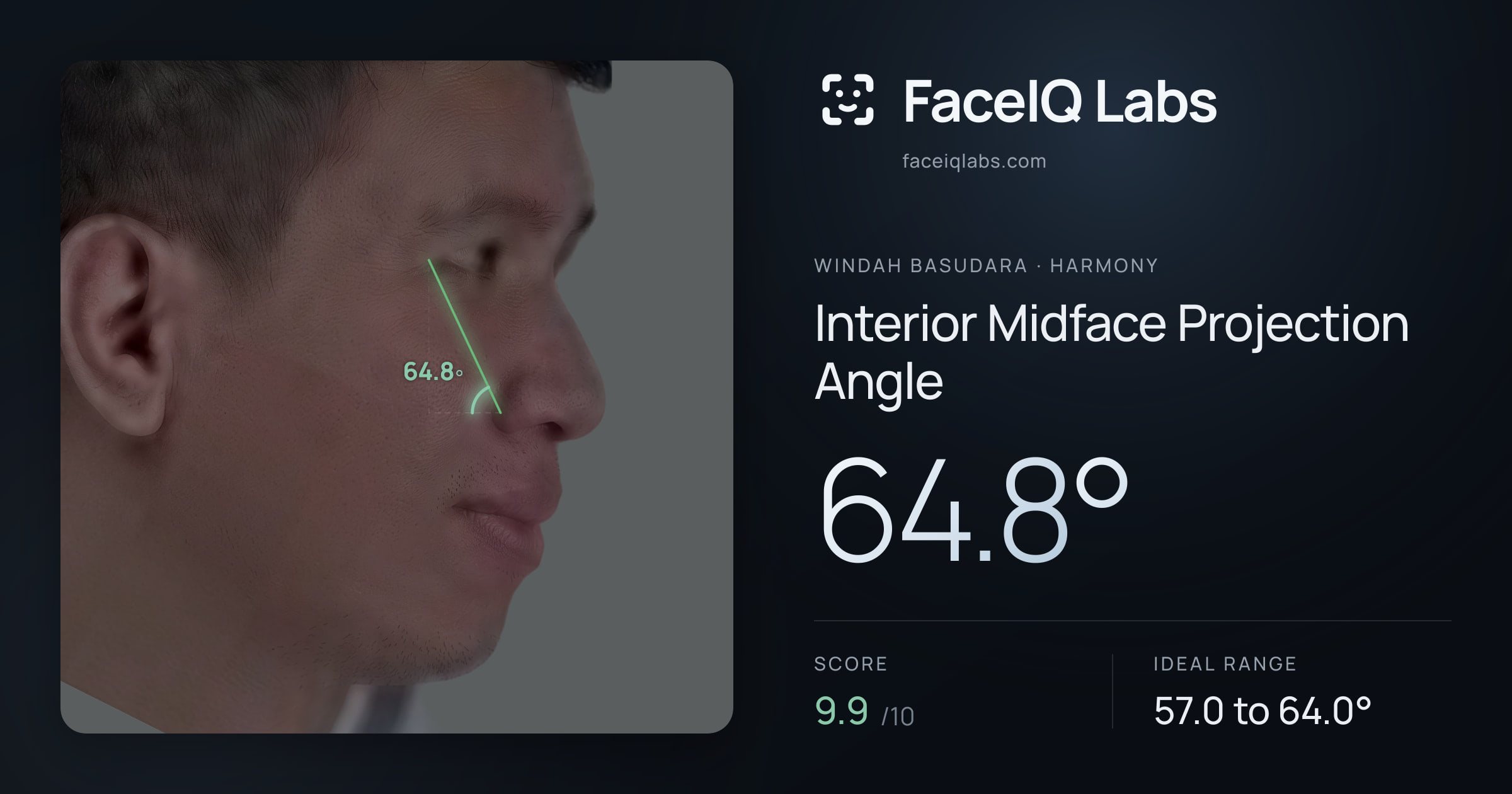 Windah Basudara Interior Midface Projection Angle: 64.8°, drawn on the photo