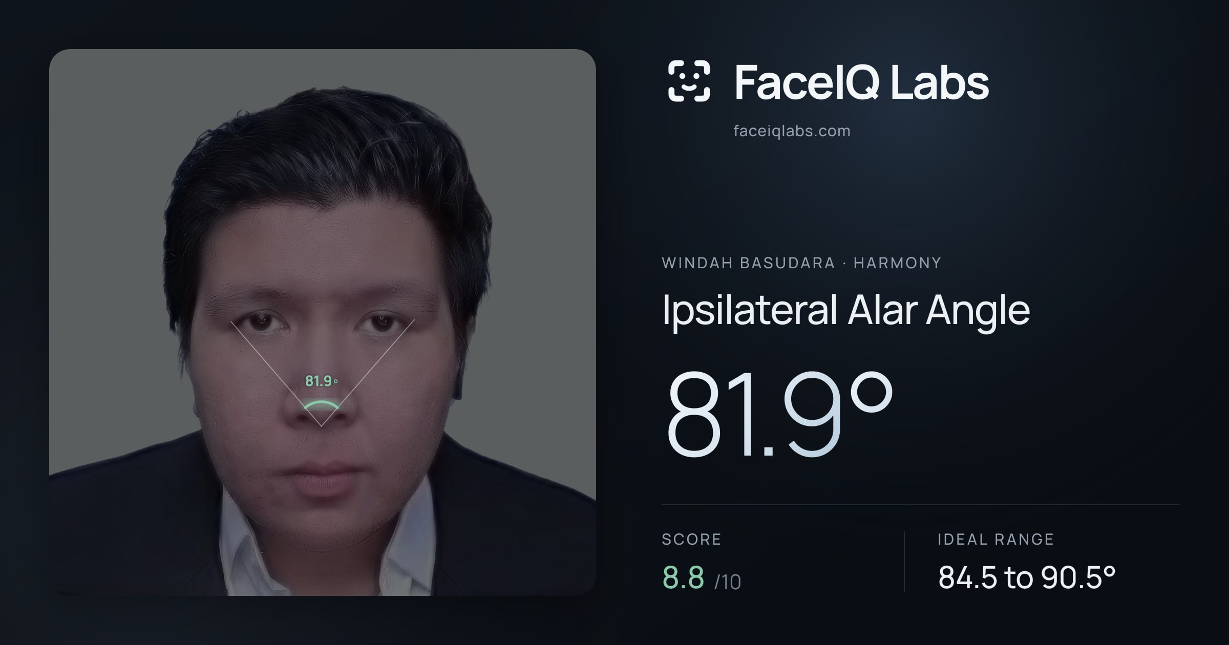 Windah Basudara Ipsilateral Alar Angle: 81.9°, drawn on the photo