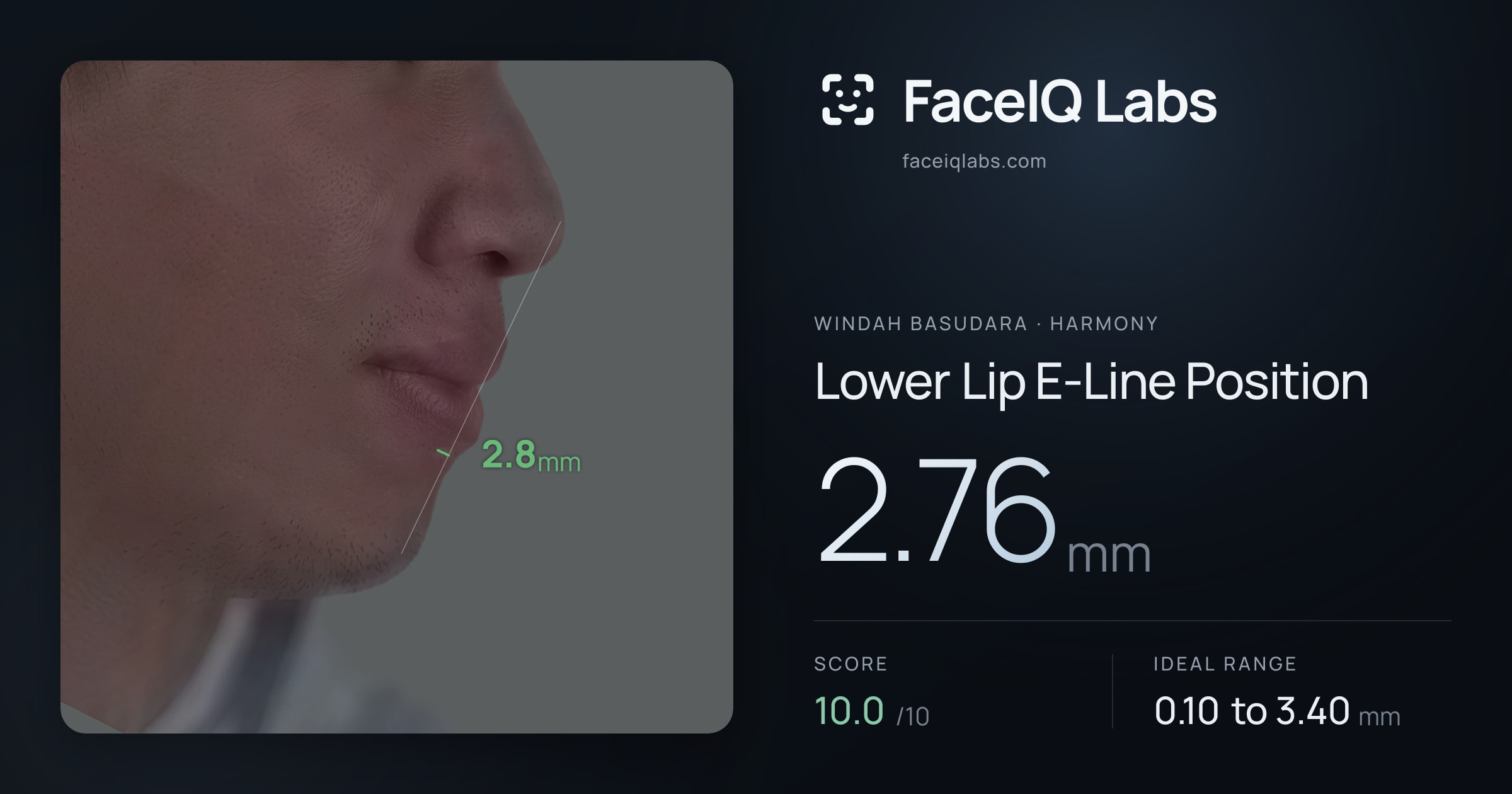 Windah Basudara Lower Lip E-Line Position: 2.76mm, drawn on the photo
