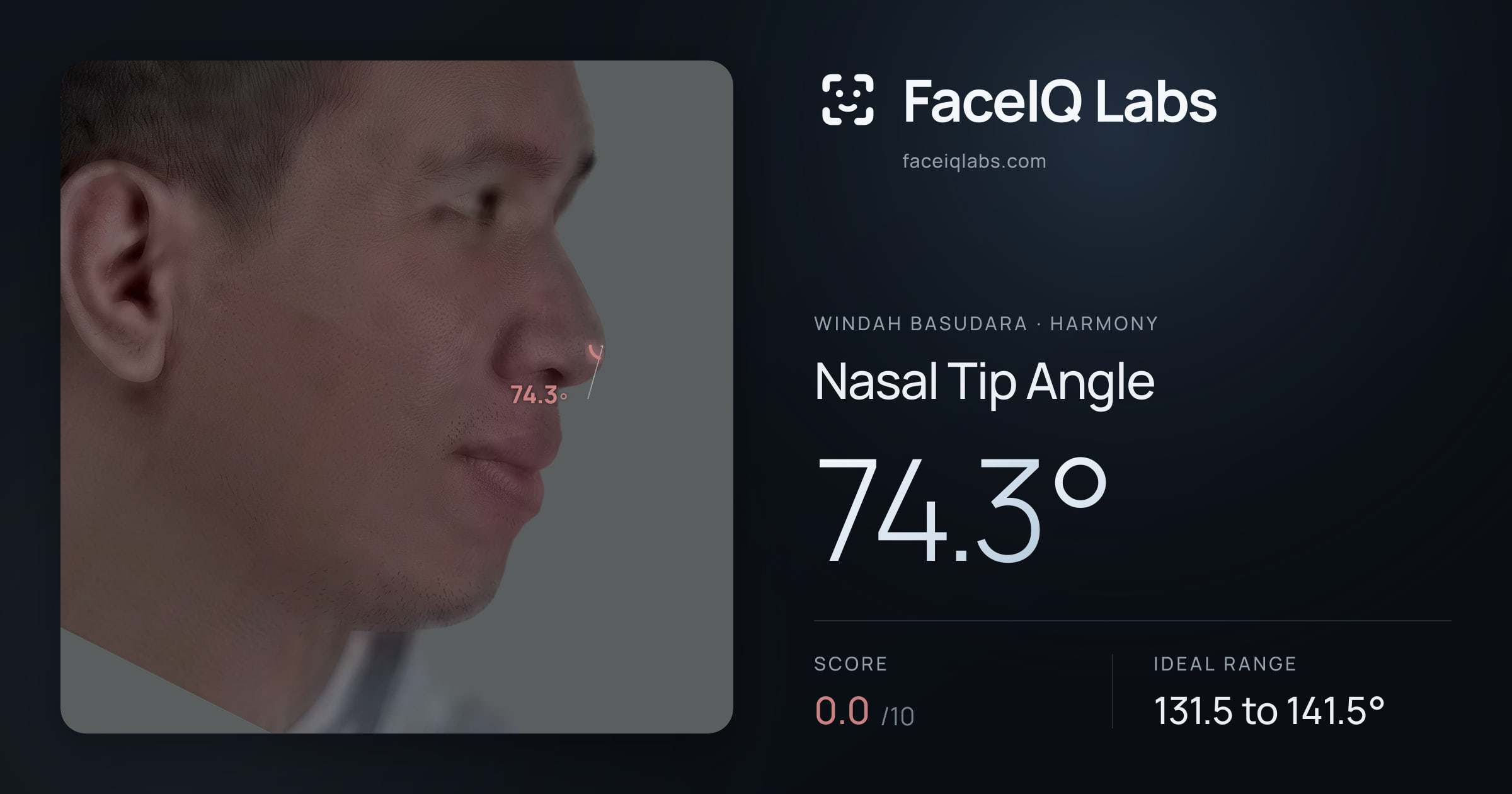 Windah Basudara Nasal Tip Angle: 74.3°, drawn on the photo
