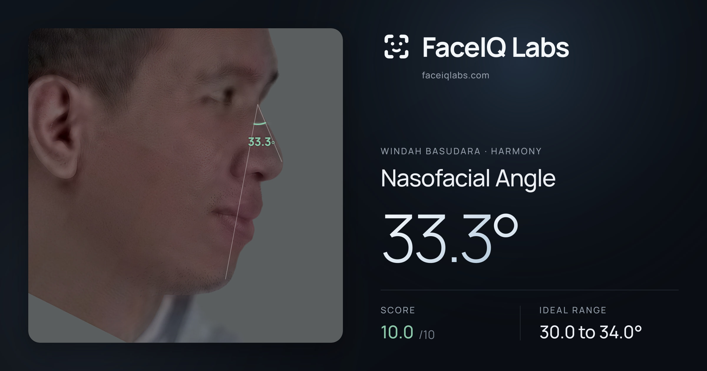 Windah Basudara Nasofacial Angle: 33.3°, drawn on the photo