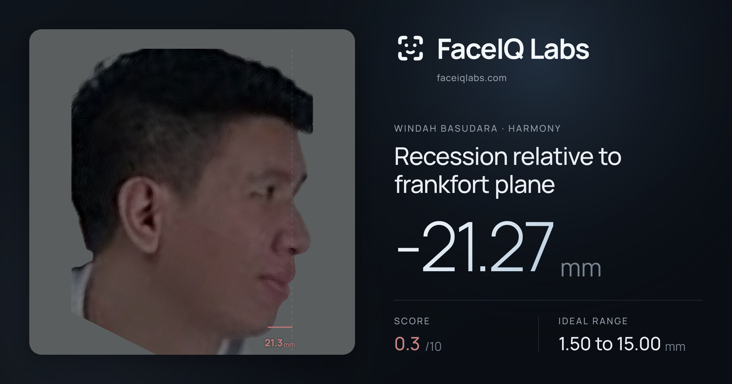 Windah Basudara Recession relative to frankfort plane: -21.27mm, drawn on the photo