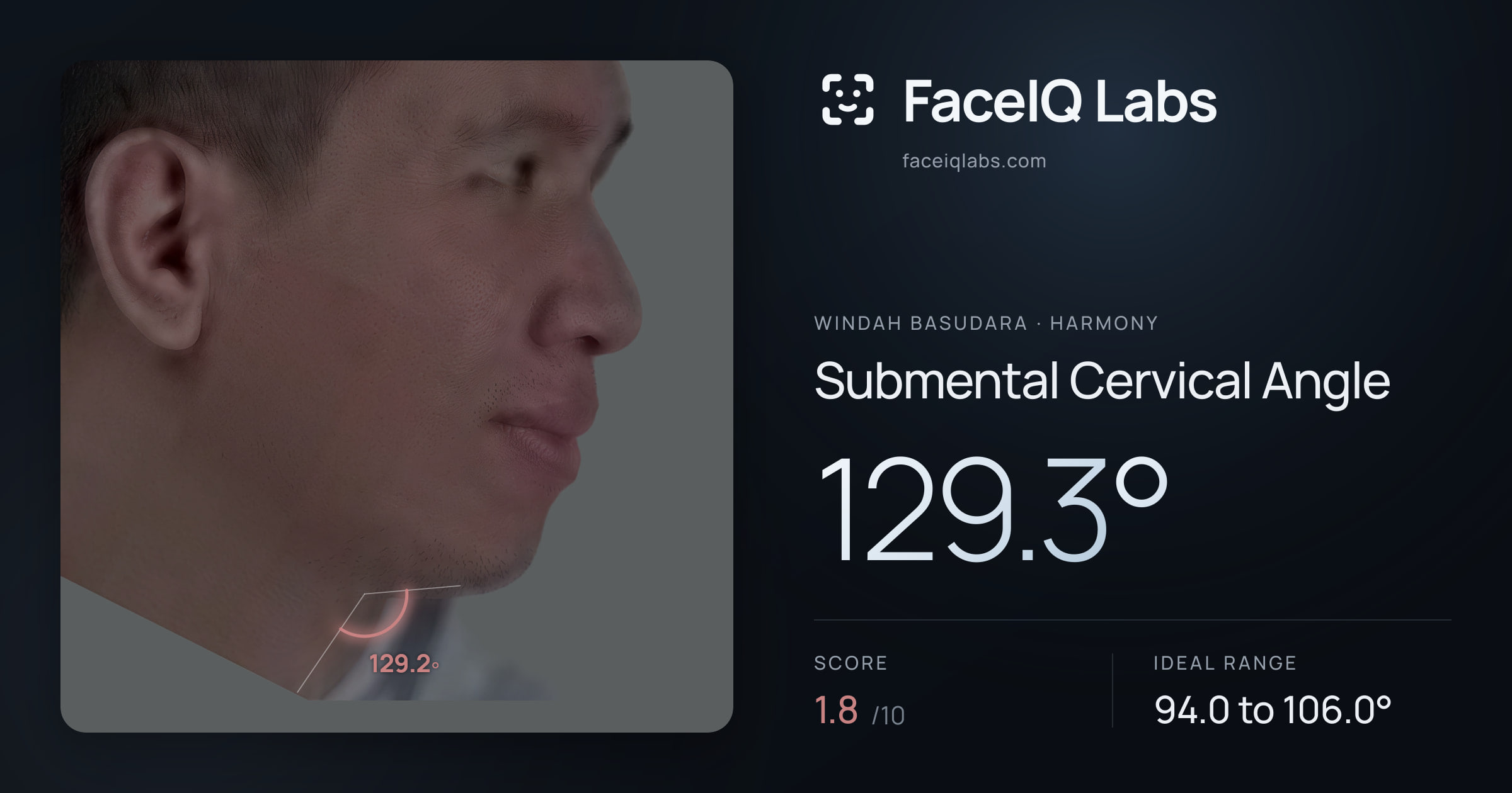 Windah Basudara Submental Cervical Angle: 129.3°, drawn on the photo