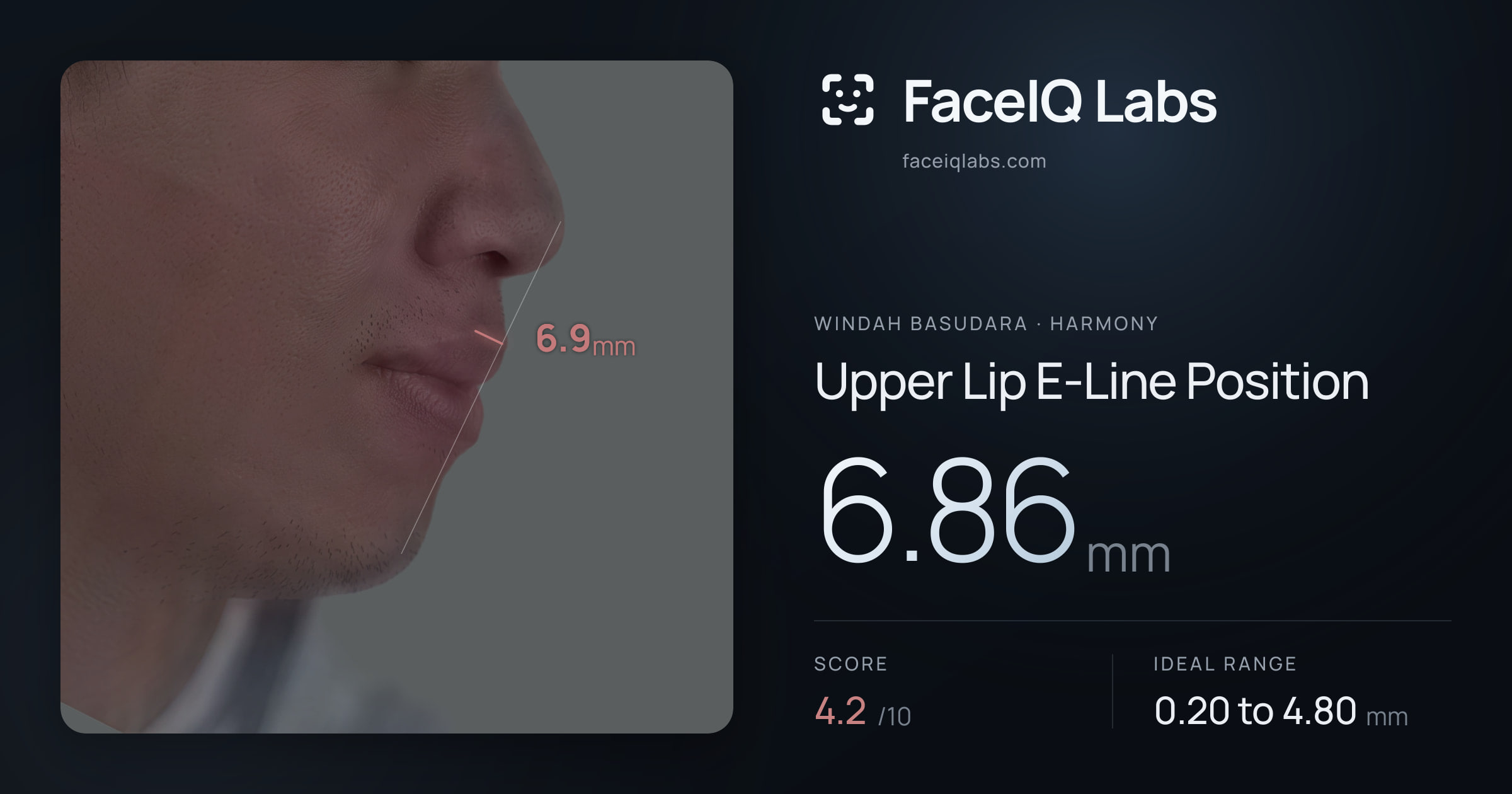 Windah Basudara Upper Lip E-Line Position: 6.86mm, drawn on the photo