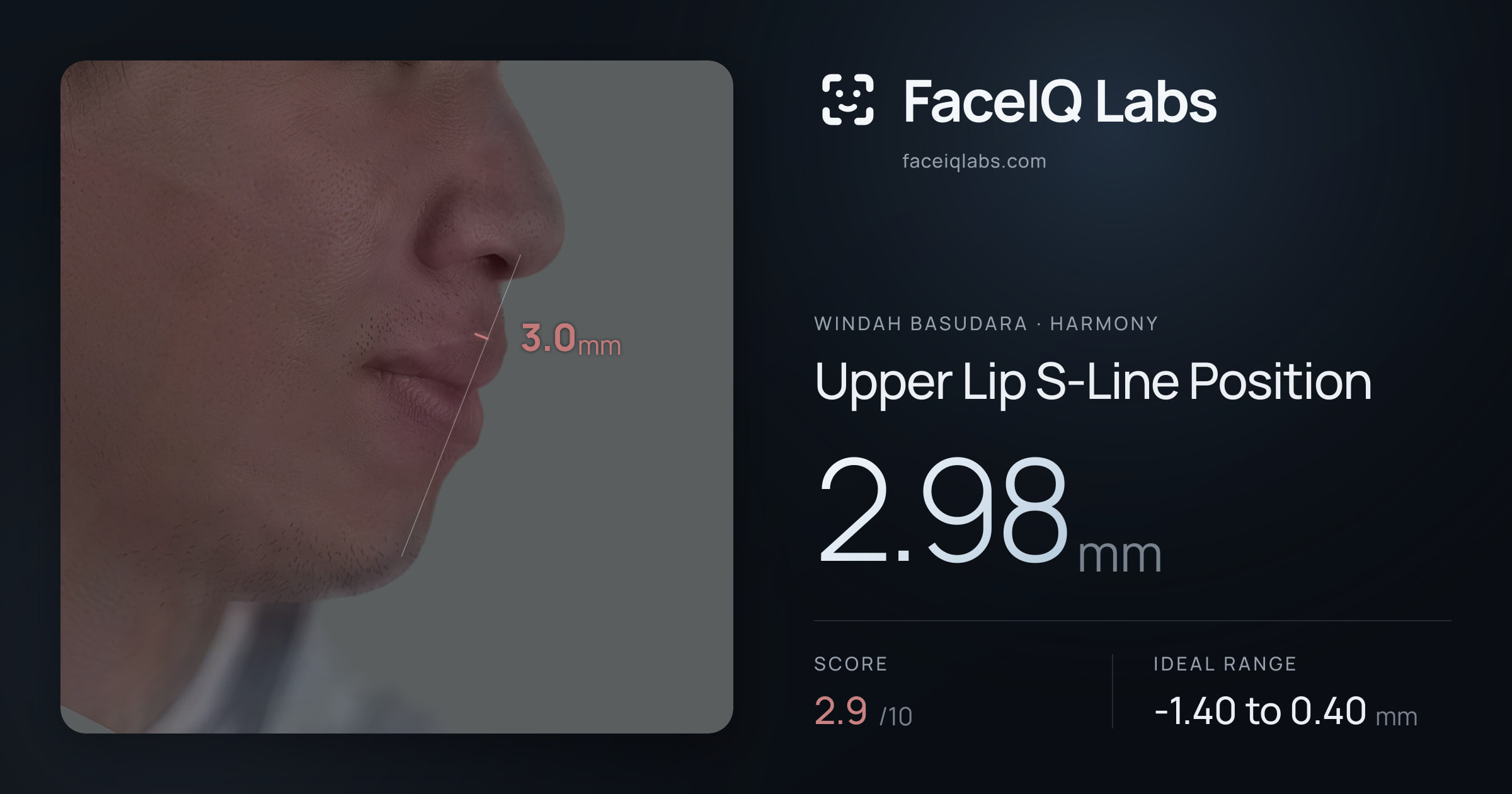 Windah Basudara Upper Lip S-Line Position: 2.98mm, drawn on the photo