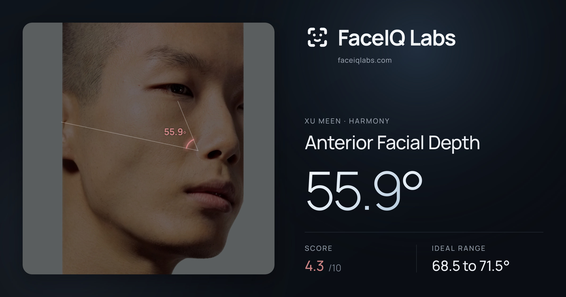 Xu Meen Anterior Facial Depth: 55.9°, drawn on the photo