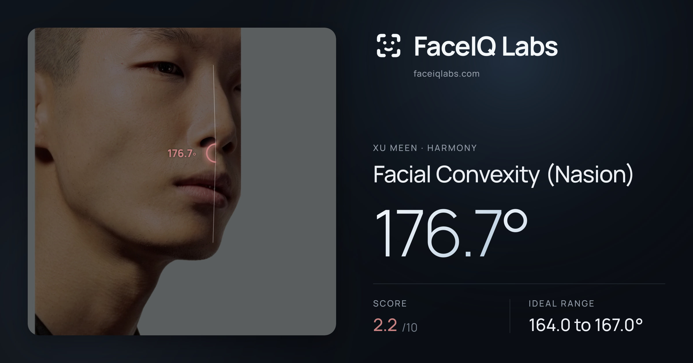 Xu Meen Facial Convexity (Nasion): 176.7°, drawn on the photo