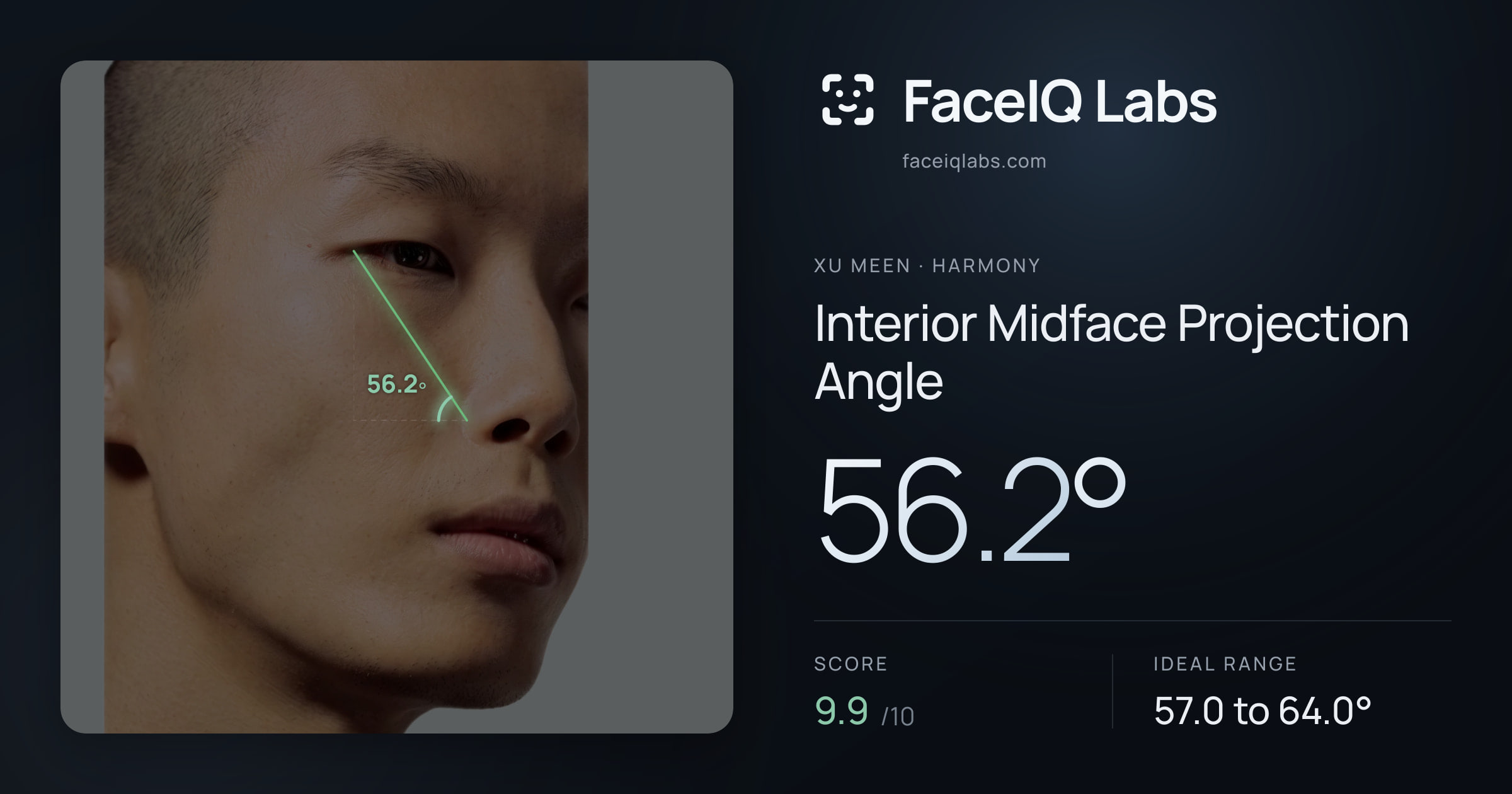 Xu Meen Interior Midface Projection Angle: 56.2°, drawn on the photo