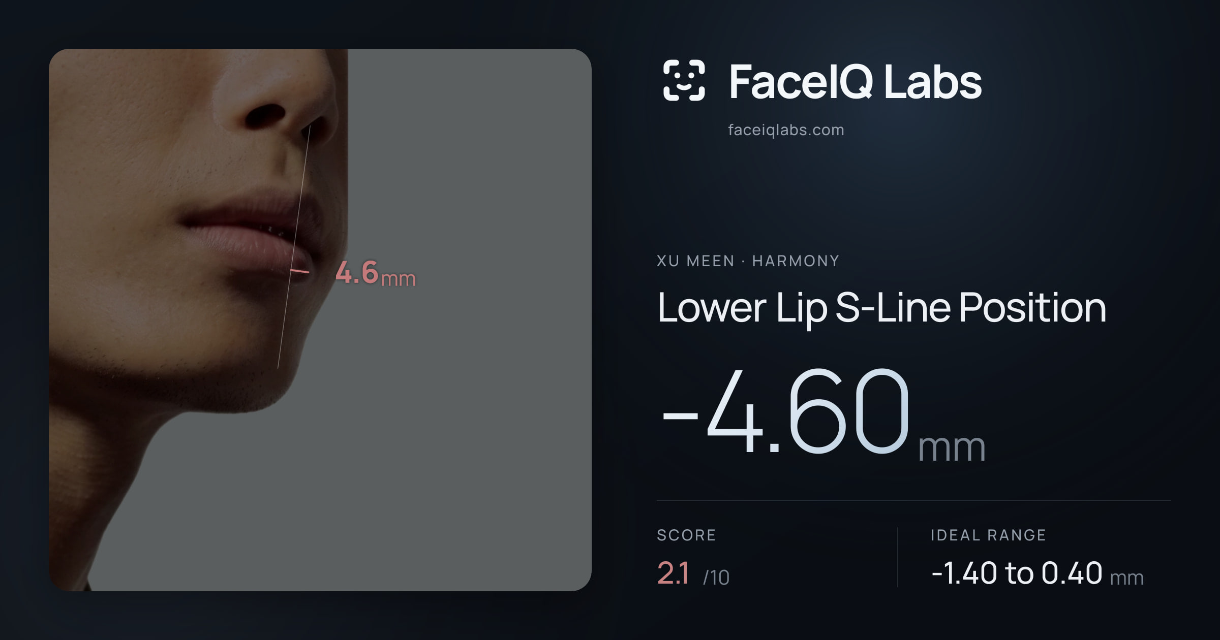Xu Meen Lower Lip S-Line Position: -4.60mm, drawn on the photo