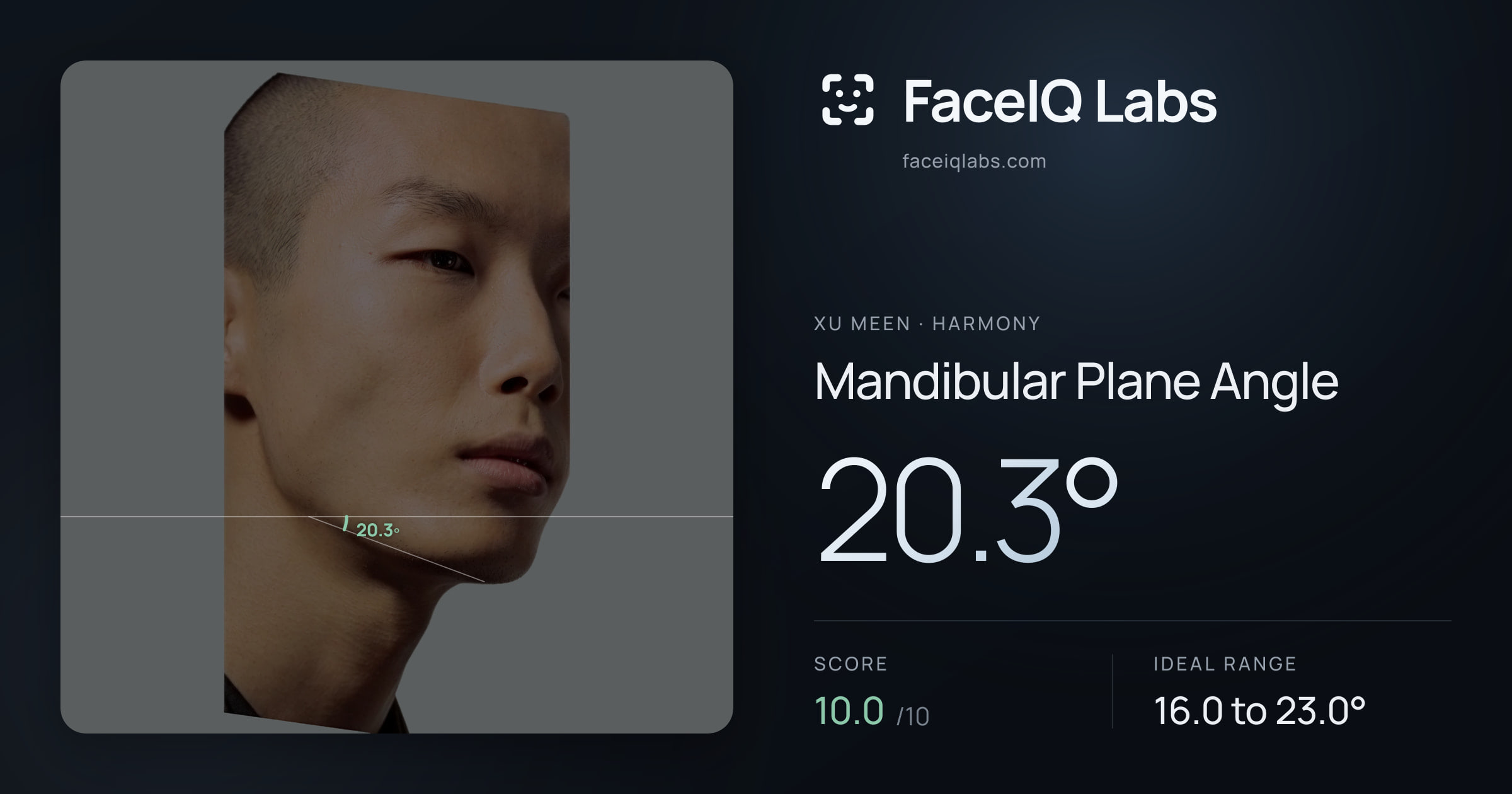 Xu Meen Mandibular Plane Angle: 20.3°, drawn on the photo