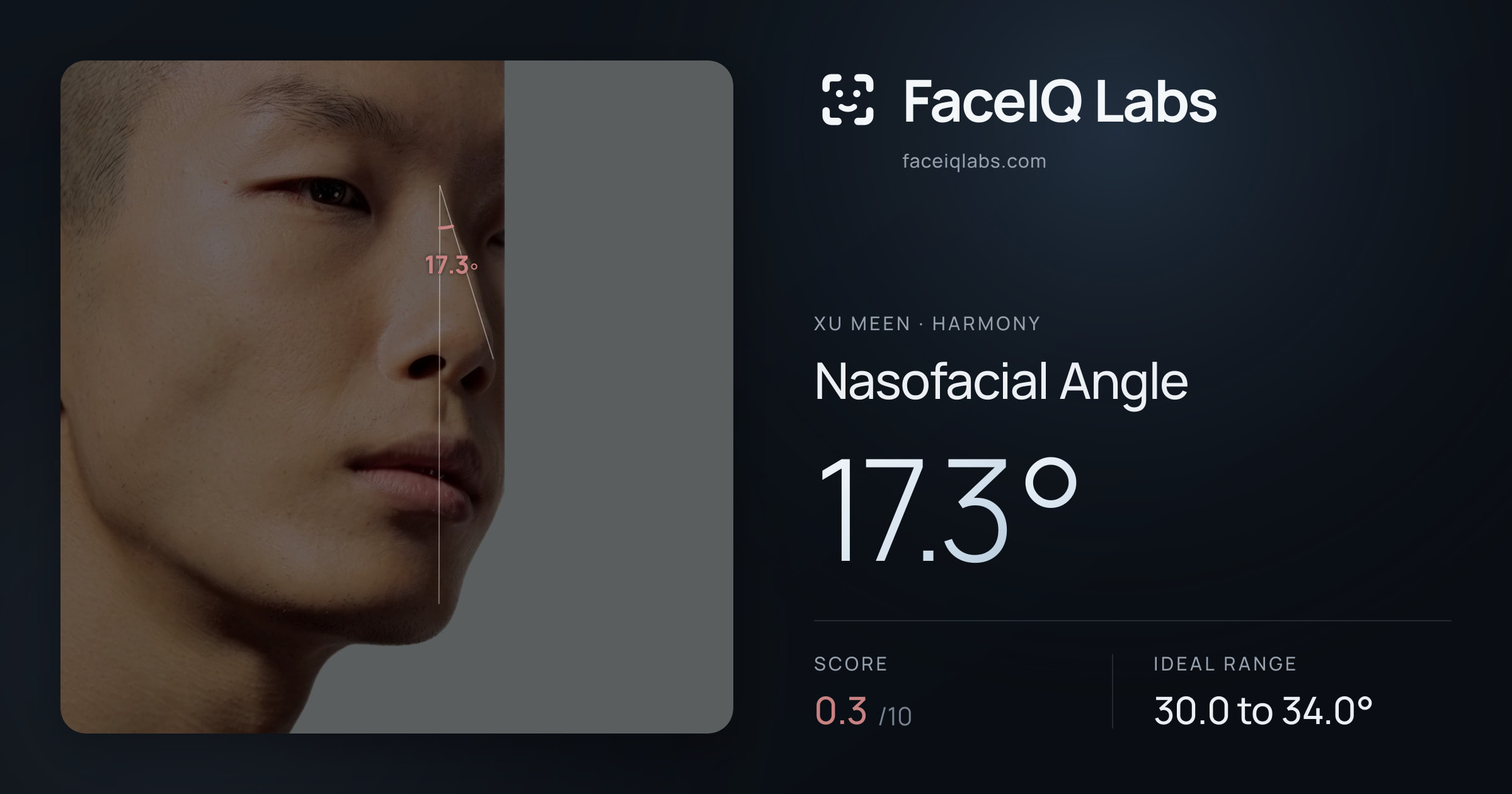 Xu Meen Nasofacial Angle: 17.3°, drawn on the photo