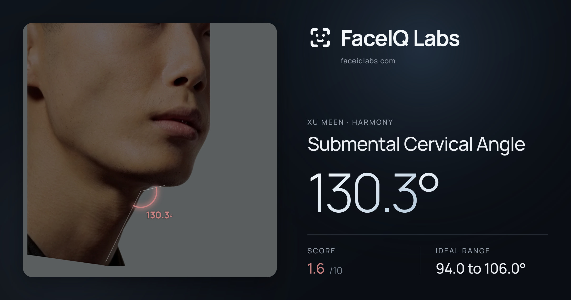 Xu Meen Submental Cervical Angle: 130.3°, drawn on the photo