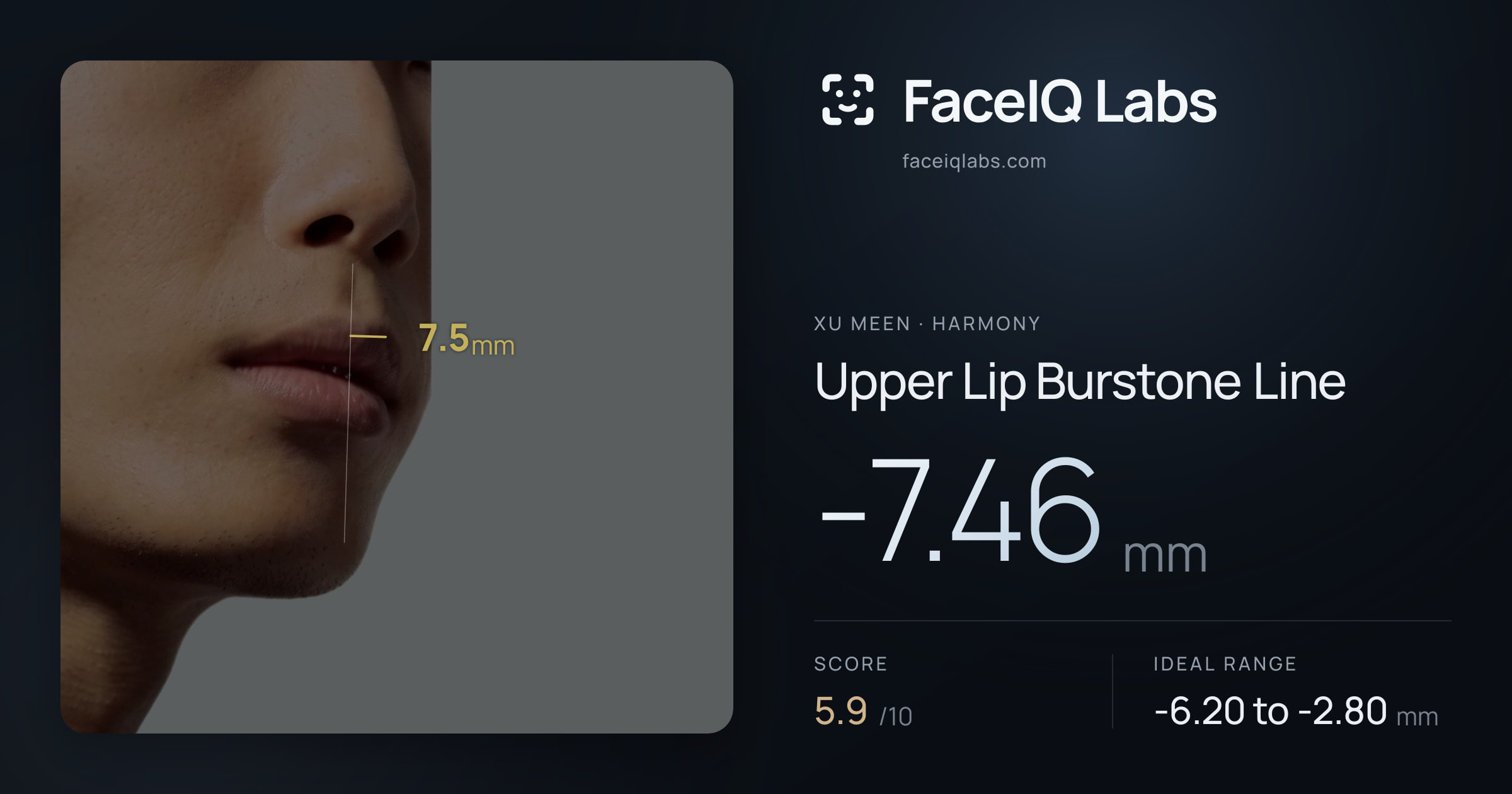 Xu Meen Upper Lip Burstone Line: -7.46mm, drawn on the photo