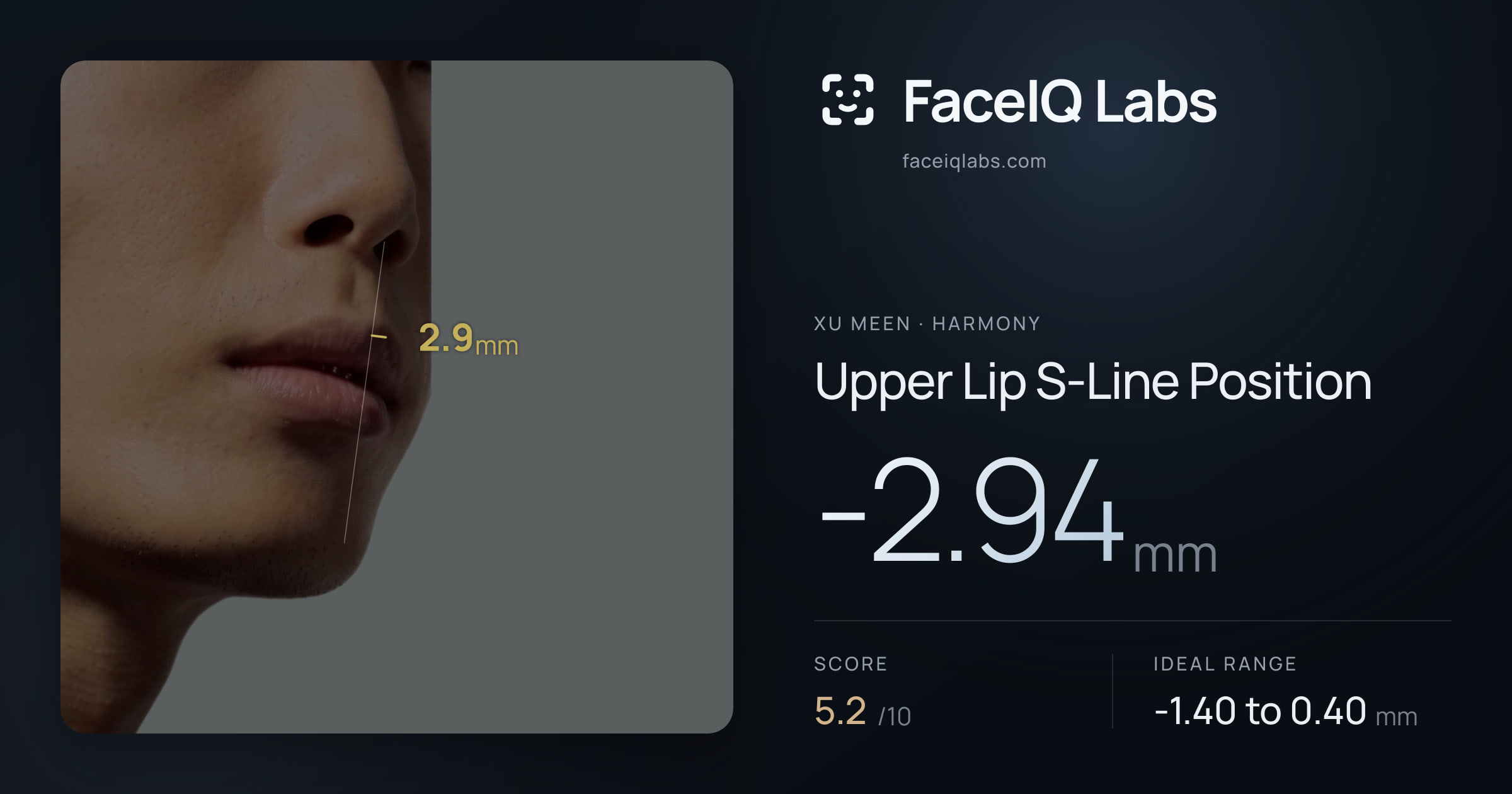 Xu Meen Upper Lip S-Line Position: -2.94mm, drawn on the photo