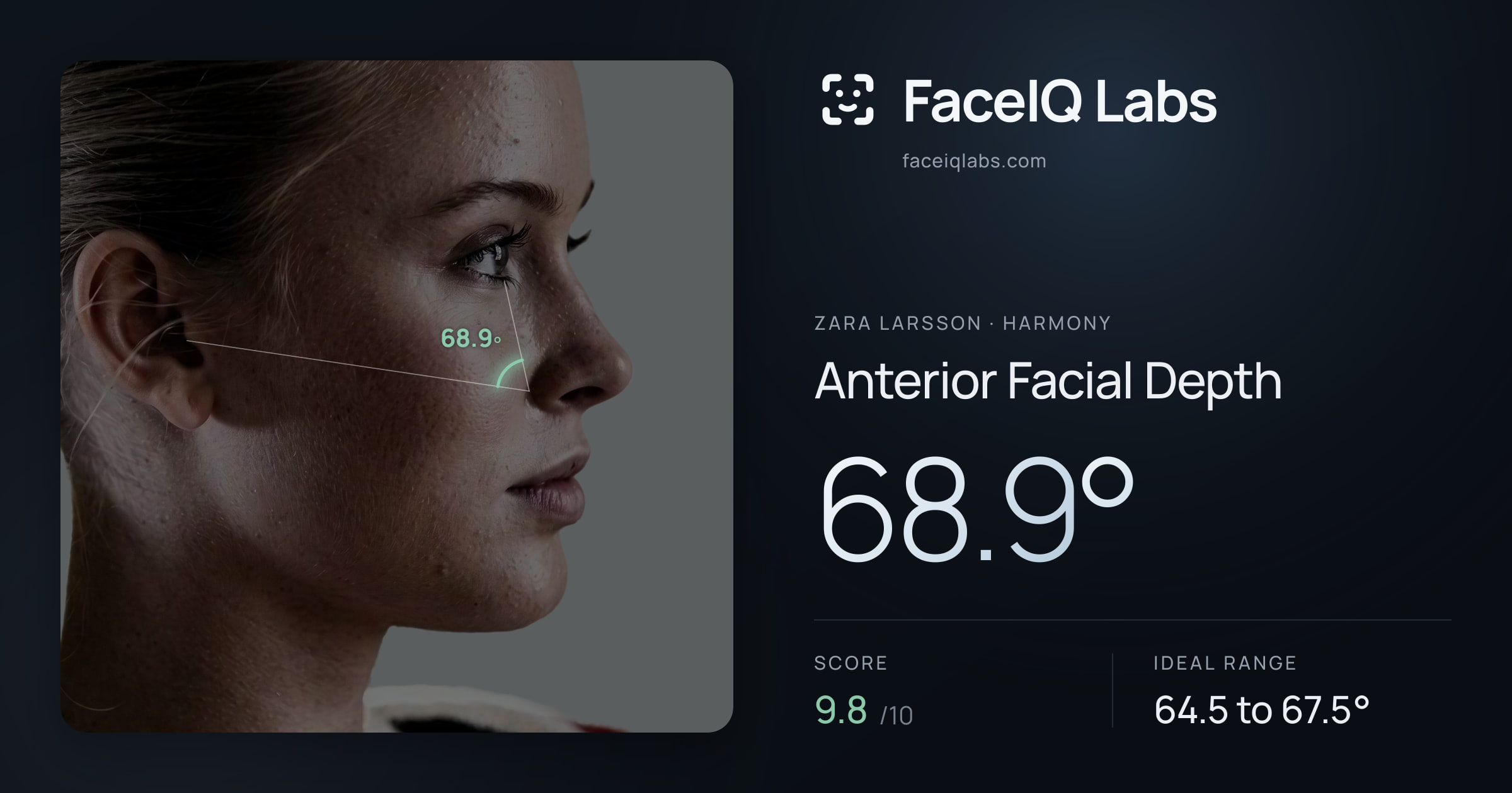 Zara Larsson Anterior Facial Depth: 68.9°, drawn on the photo
