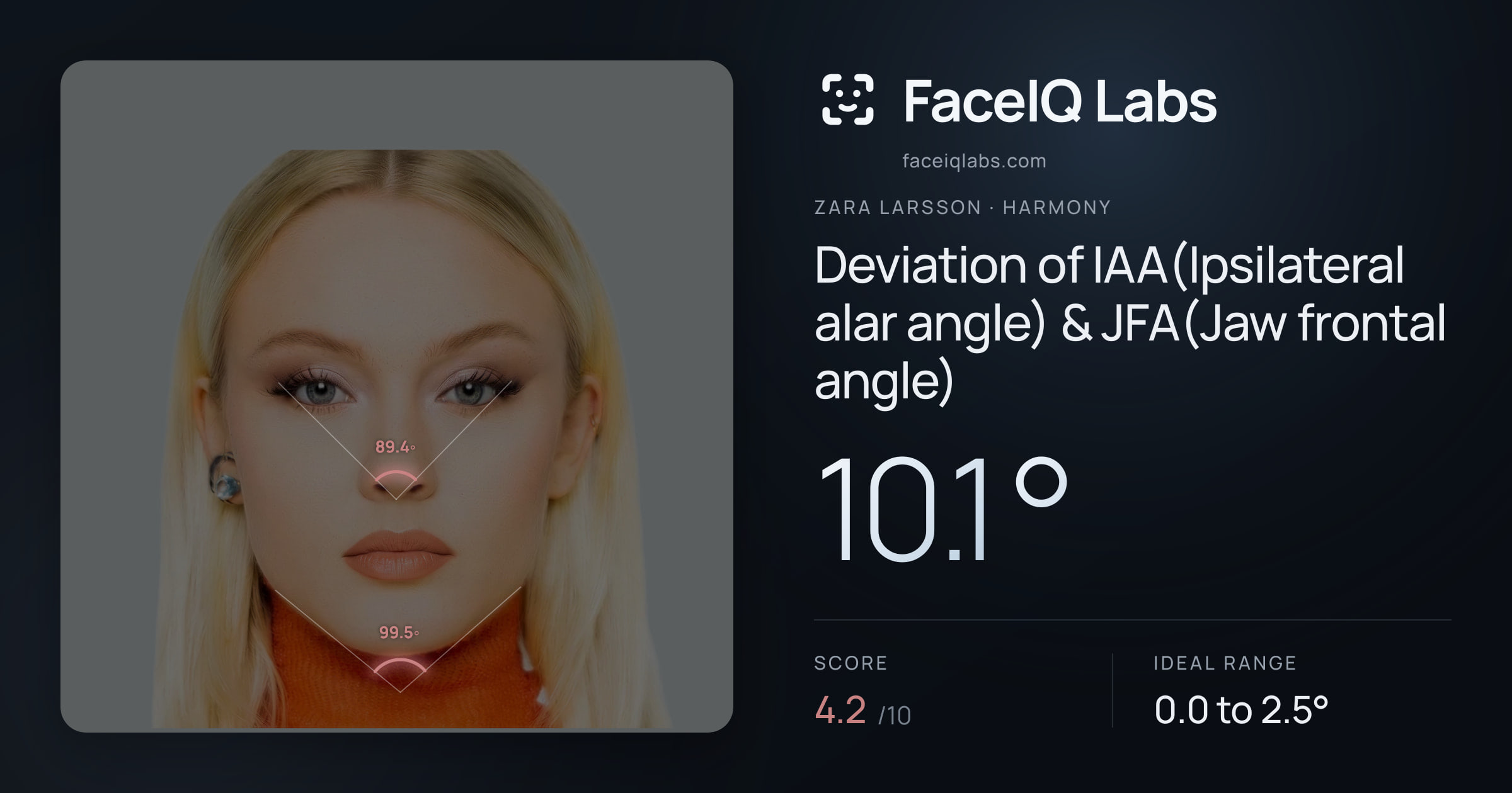Zara Larsson Deviation of IAA(Ipsilateral alar angle) & JFA(Jaw frontal angle): 10.1°, drawn on the photo