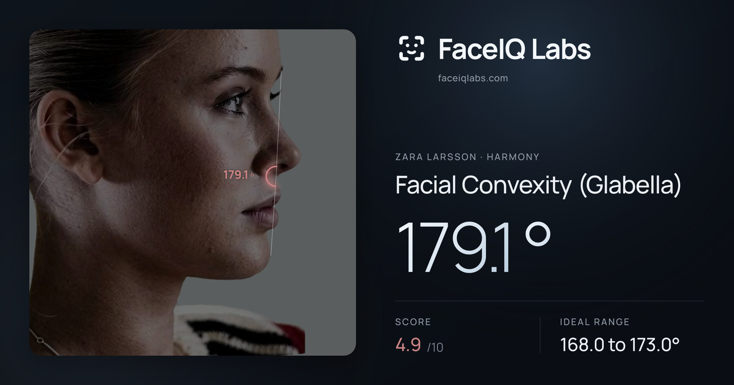 Zara Larsson Facial Convexity (Glabella): 179.1°, drawn on the photo