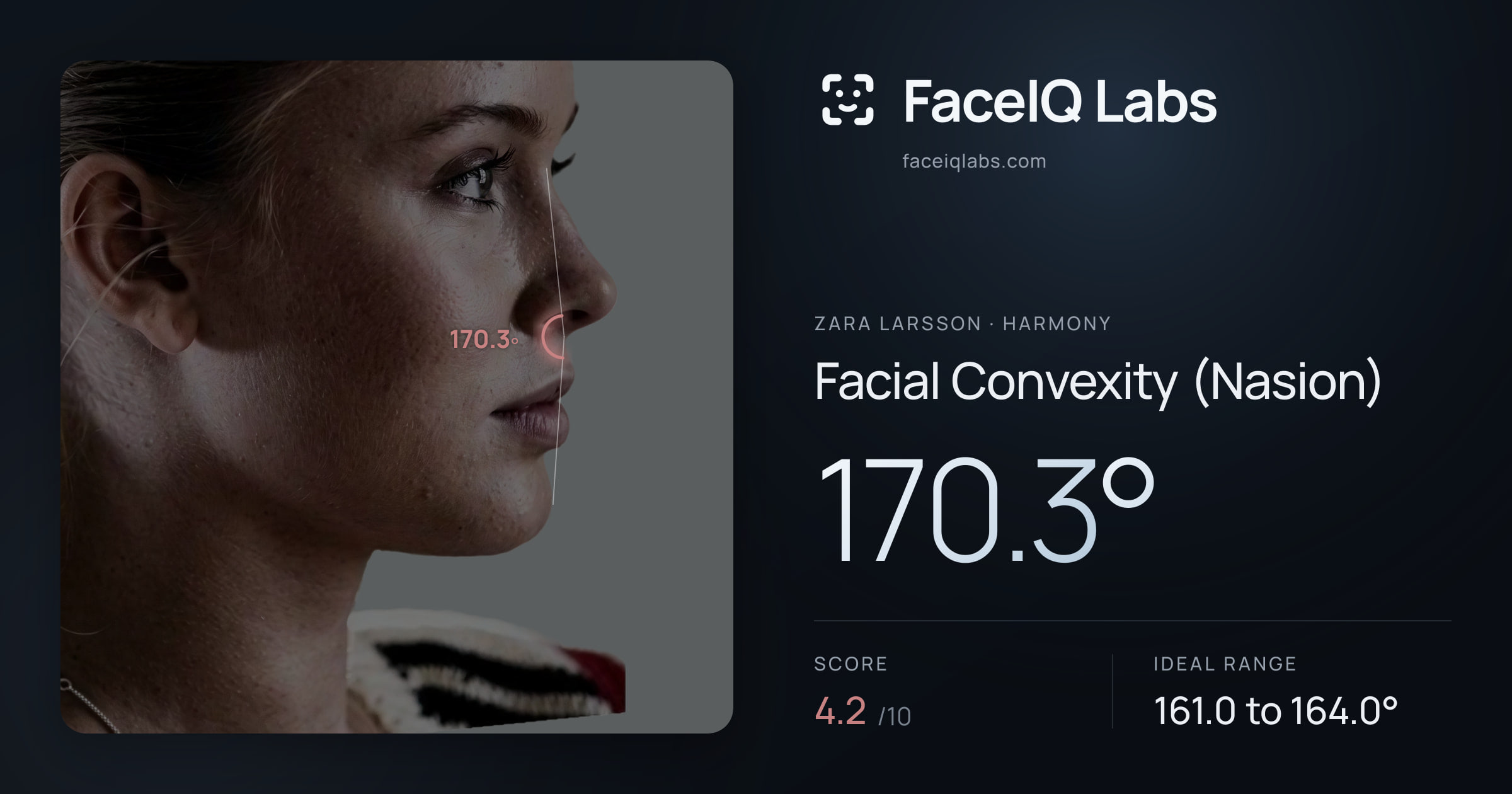 Zara Larsson Facial Convexity (Nasion): 170.3°, drawn on the photo