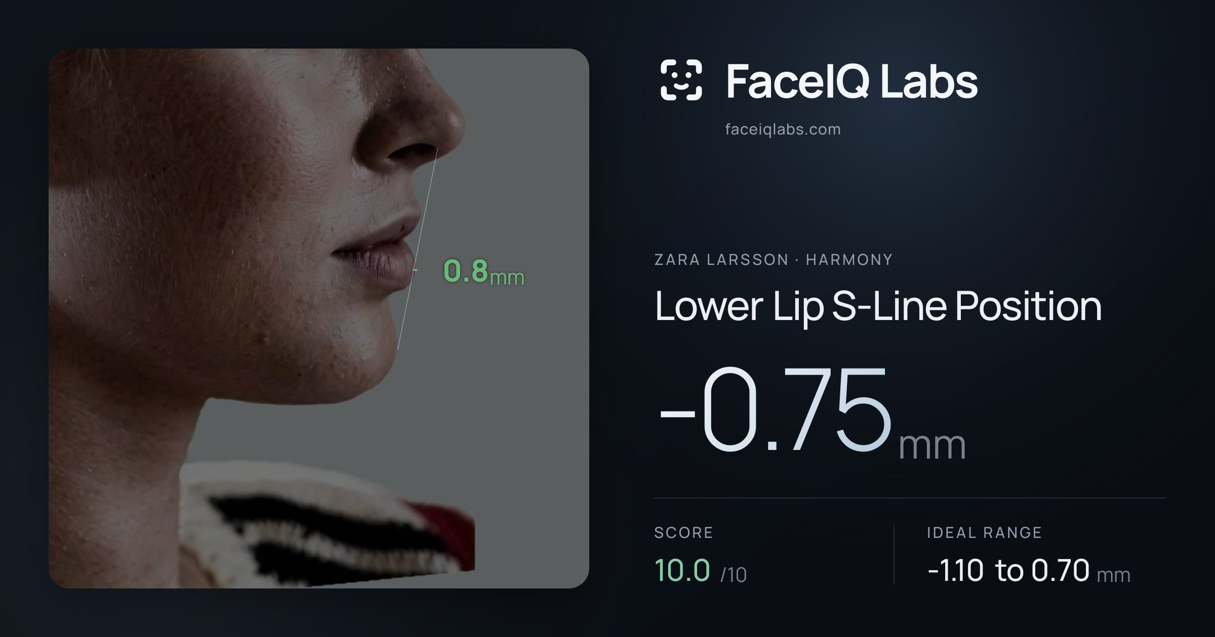 Zara Larsson Lower Lip S-Line Position: -0.75mm, drawn on the photo