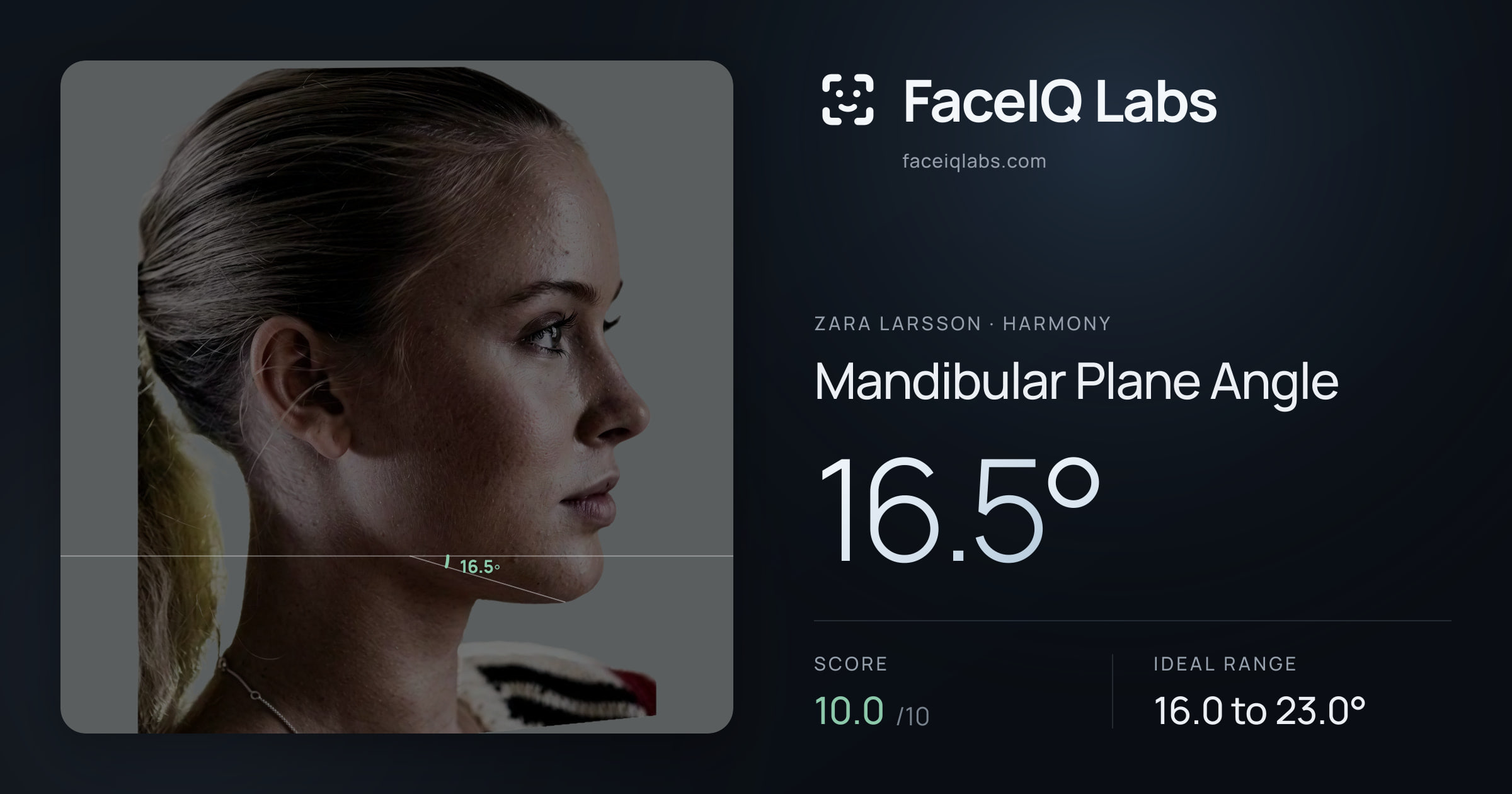 Zara Larsson Mandibular Plane Angle: 16.5°, drawn on the photo