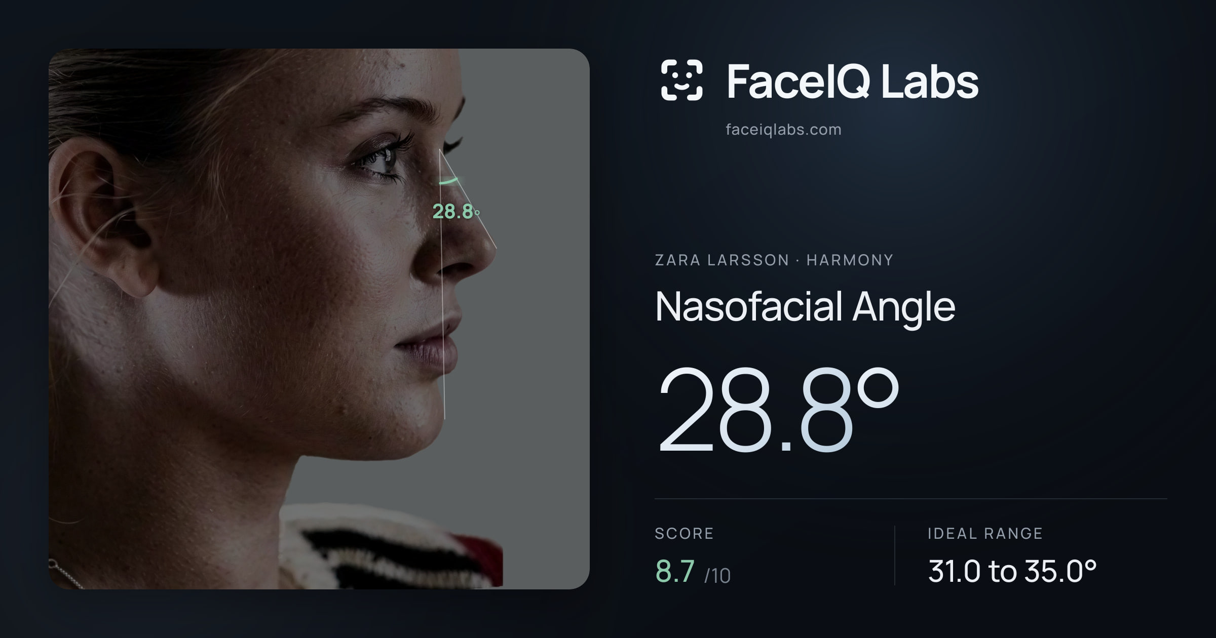 Zara Larsson Nasofacial Angle: 28.8°, drawn on the photo