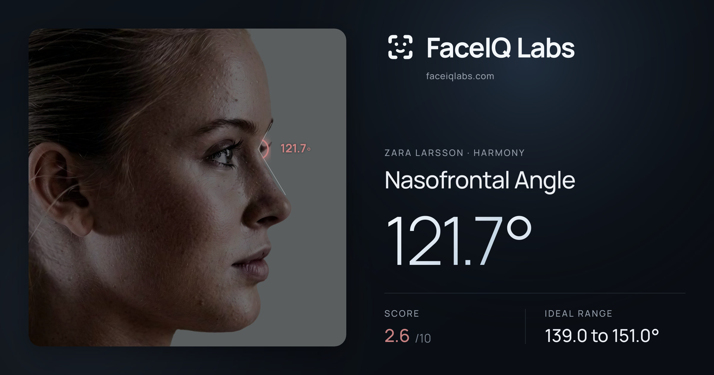 Zara Larsson Nasofrontal Angle: 121.7°, drawn on the photo