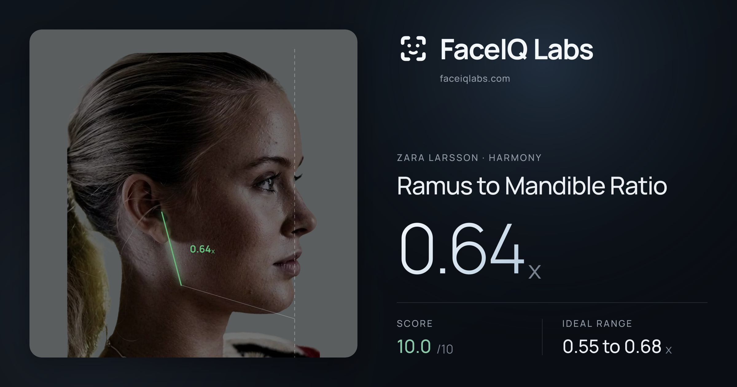 Zara Larsson Ramus to Mandible Ratio: 0.64x, drawn on the photo