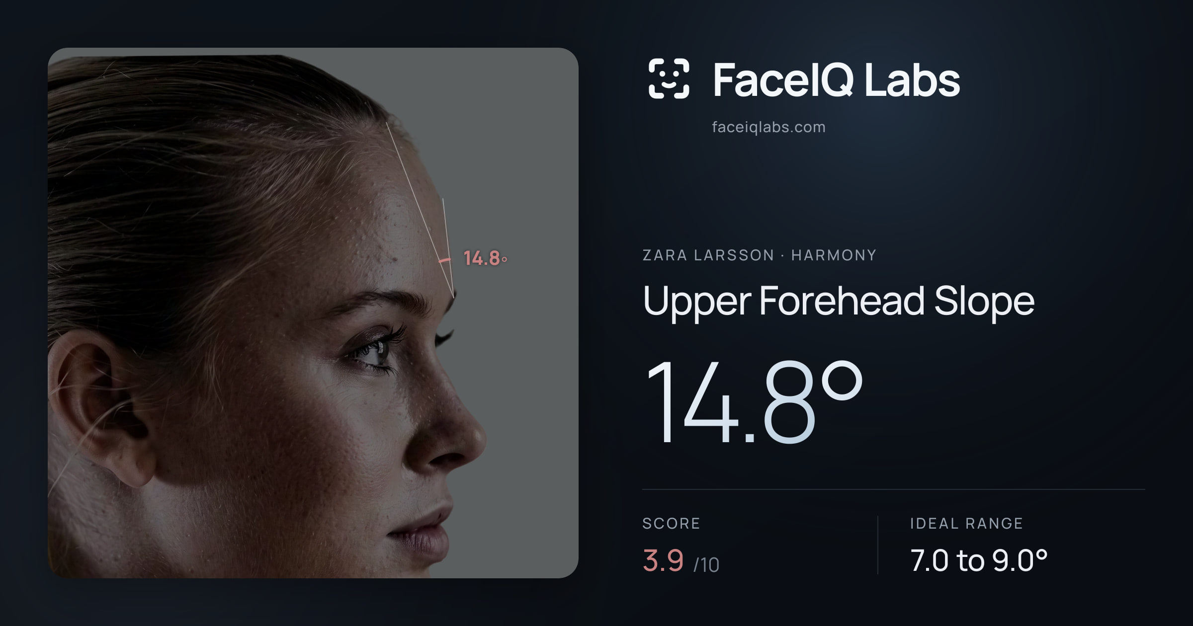 Zara Larsson Upper Forehead Slope: 14.8°, drawn on the photo