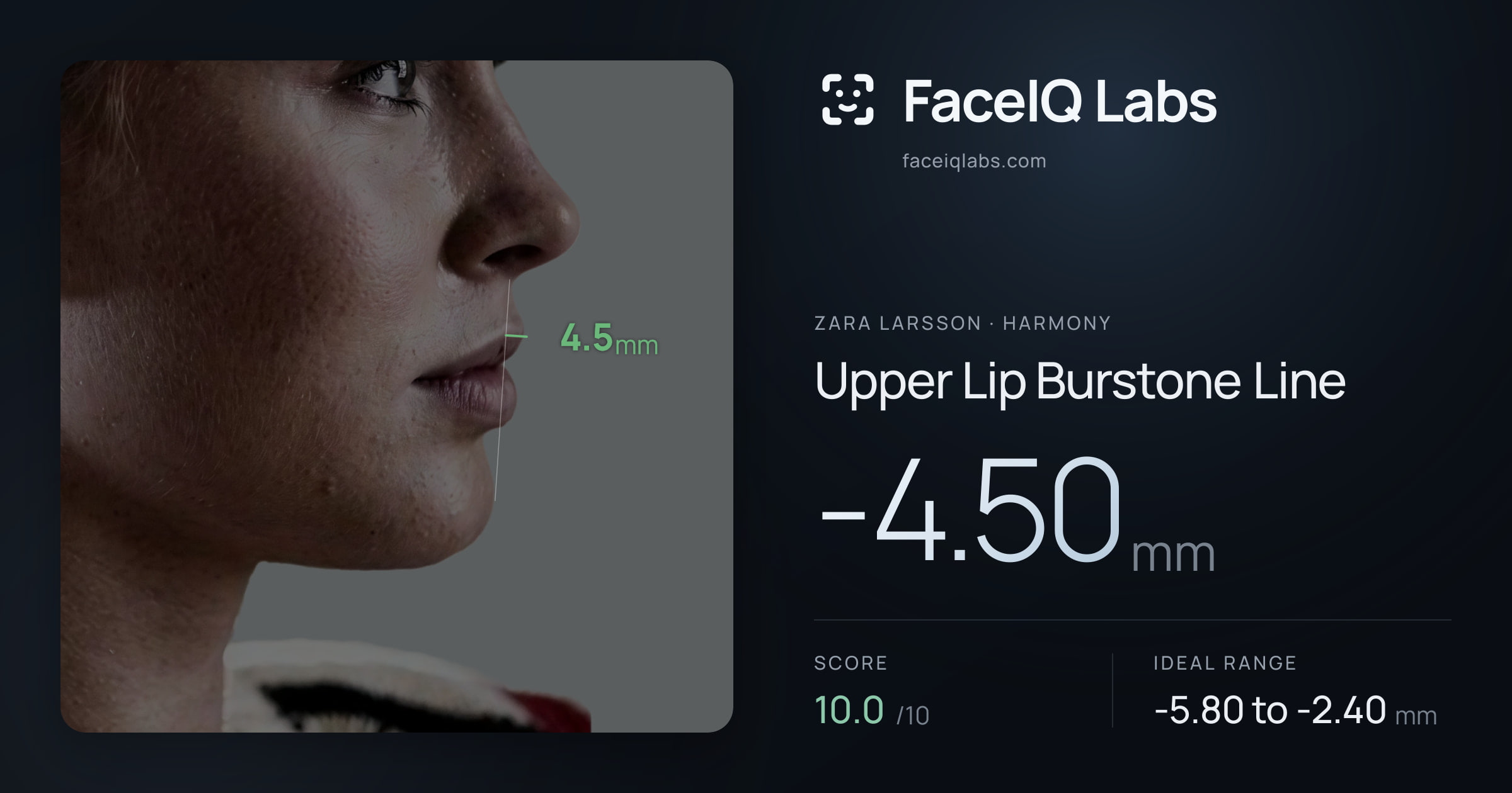 Zara Larsson Upper Lip Burstone Line: -4.50mm, drawn on the photo