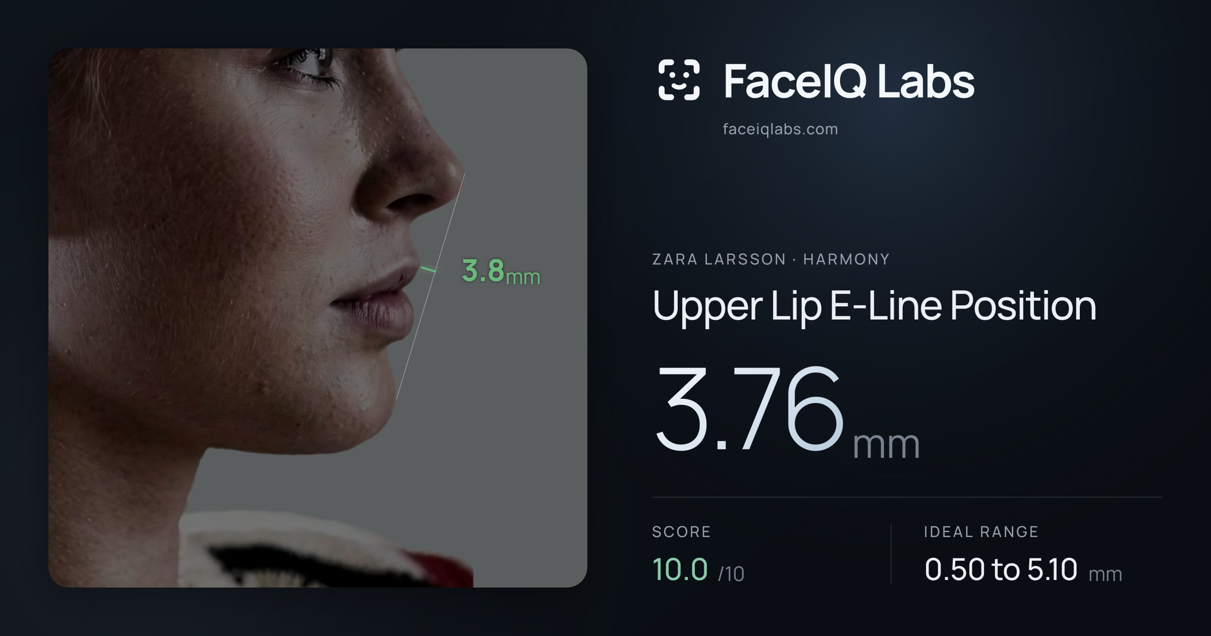 Zara Larsson Upper Lip E-Line Position: 3.76mm, drawn on the photo