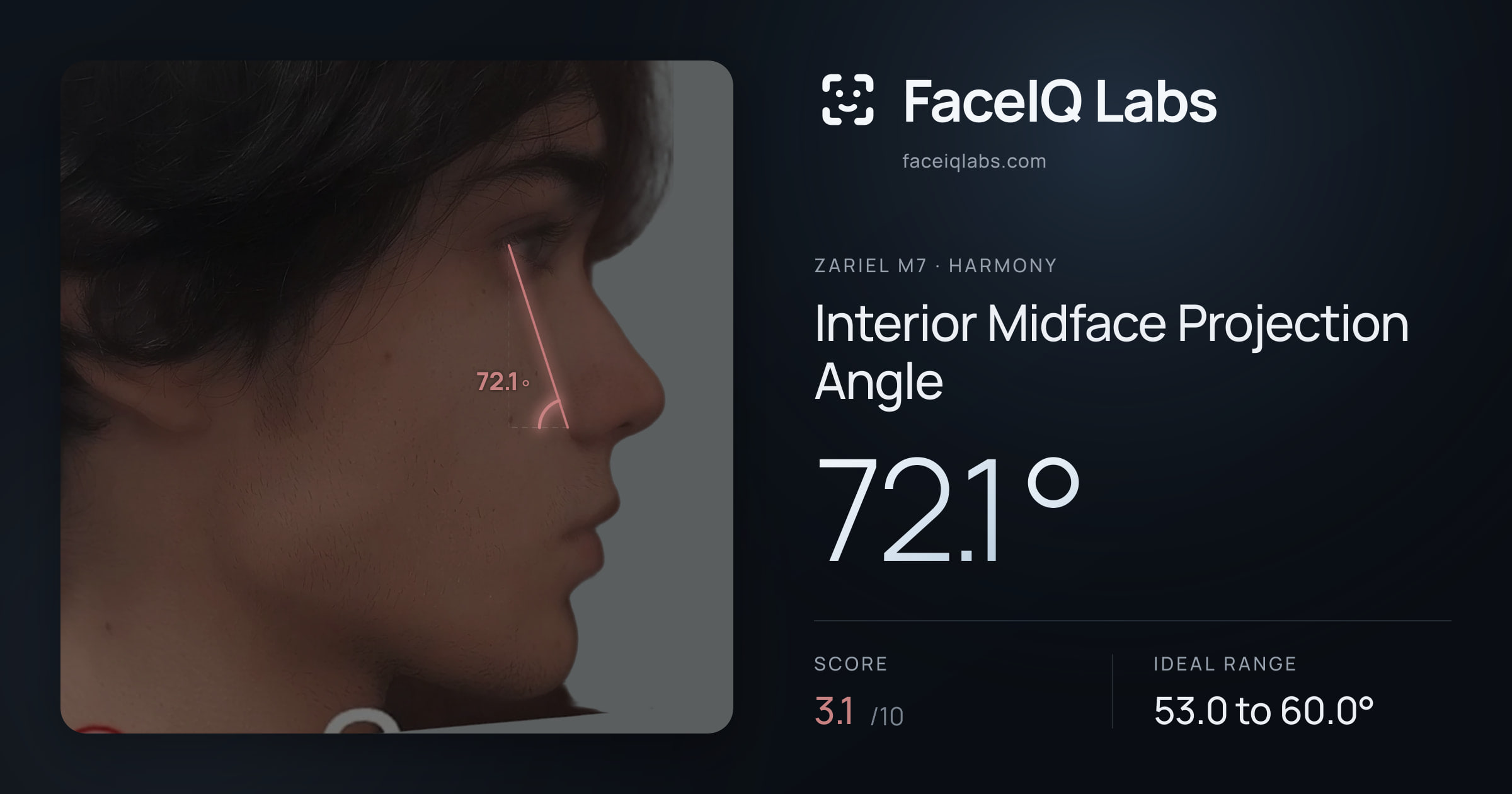Zariel M7 Interior Midface Projection Angle: 72.1°, drawn on the photo