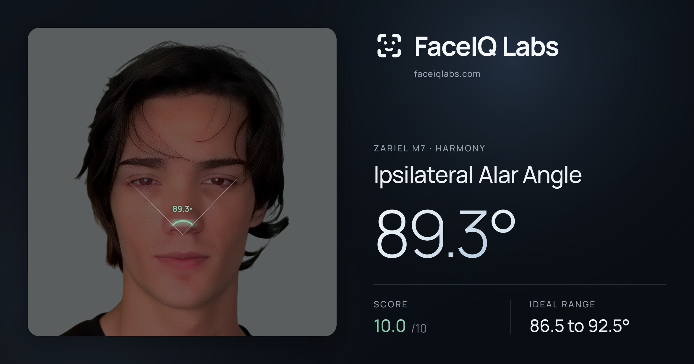 Zariel M7 Ipsilateral Alar Angle: 89.3°, drawn on the photo